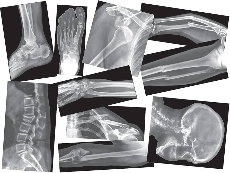 Roylco Broken Bones X-Ray Set, Projector Display Compatible, 15 X-Rays | Amazon (US)