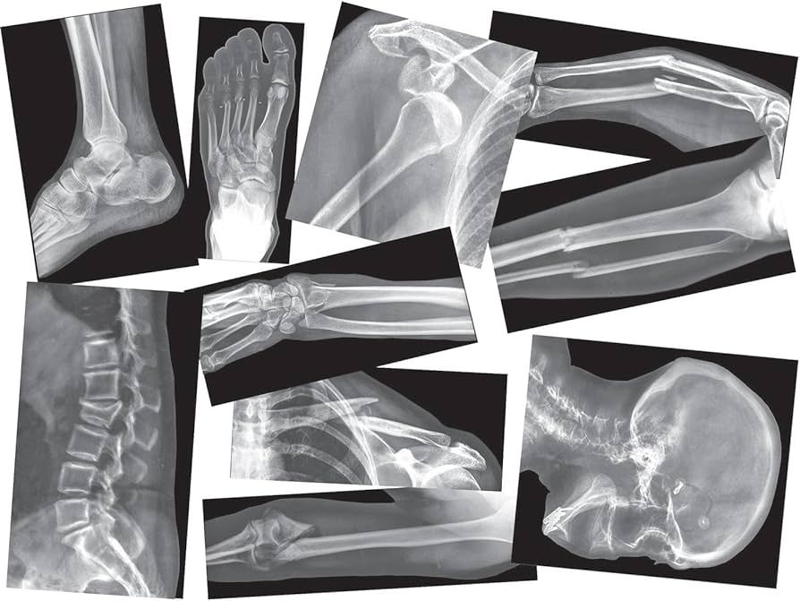 Roylco Broken Bones X-Ray Set, Projector Display Compatible, 15 X-Rays | Amazon (US)