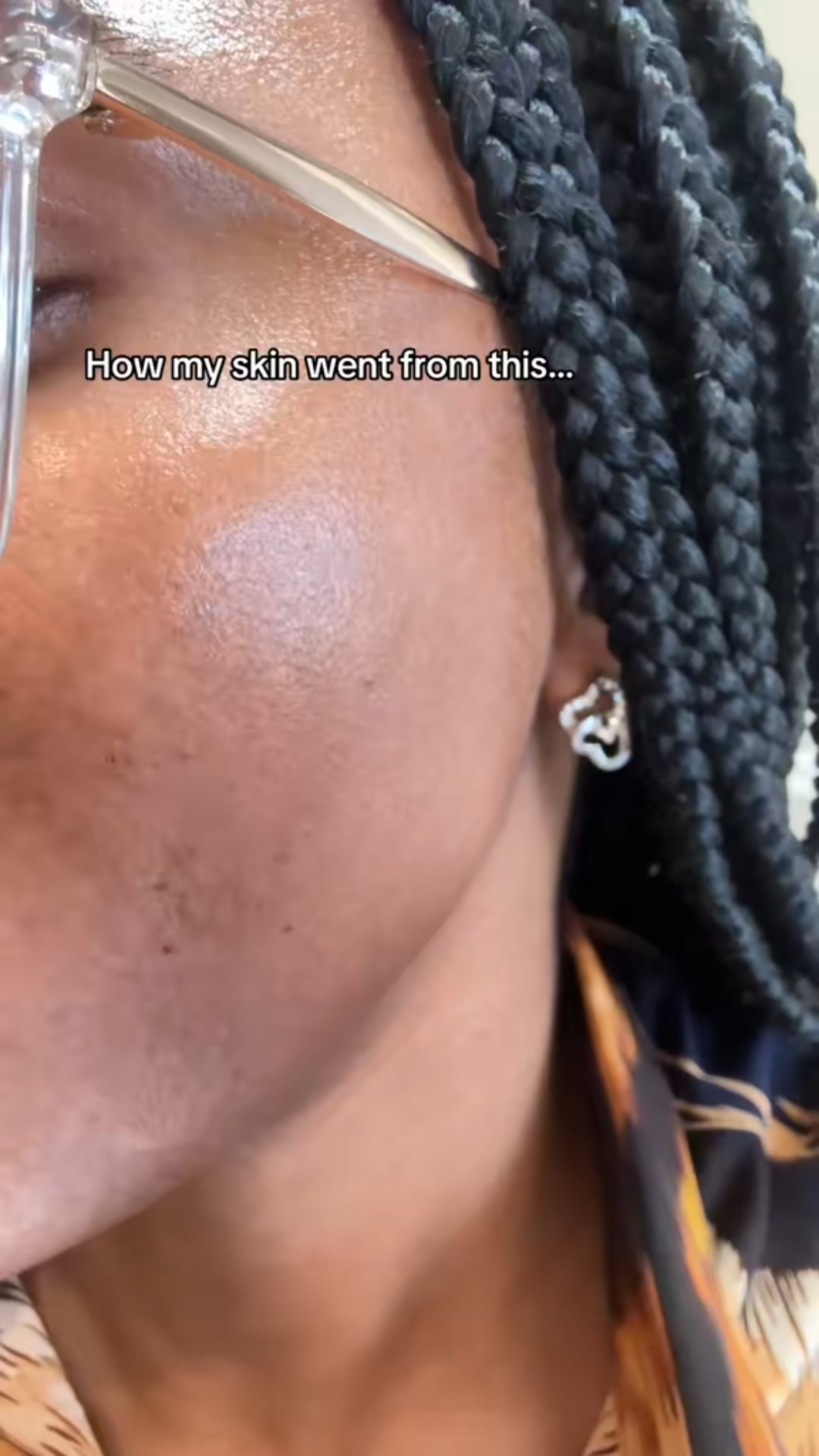 My struggle with hyperpigmentation 

#LTKBeauty #LTKselfcare #LTKHoliday