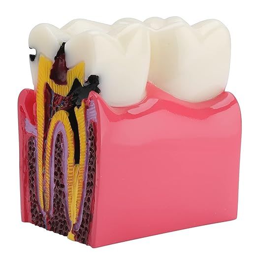 Dental Caries Tooth Model - 6 Times Caries Anatomy Dental Care Teeth Model Decay Teeth Comparativ... | Amazon (US)