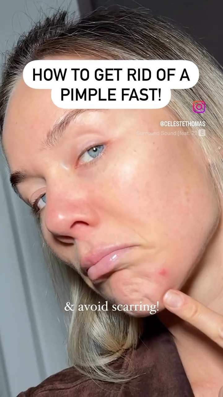 Tools to get rid of a pimple fast! Nontoxic, non pore clogging! 

#LTKTravel #LTKBeauty #LTKGiftGuide