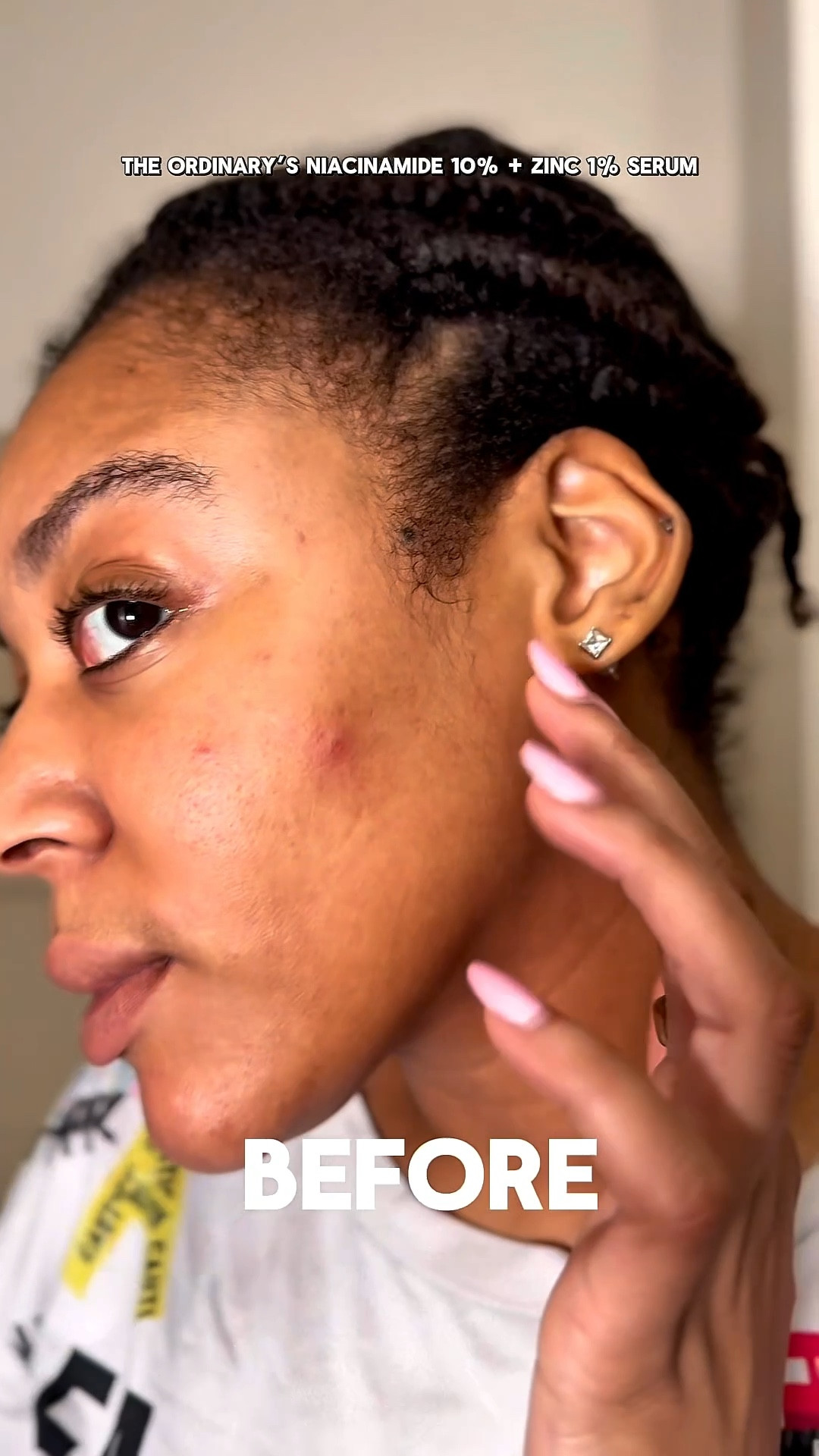 After a week of using The Ordinary Niacinamide serum I’m pleasantly impressed by my results☺️✨ #theordinary #skincare 

#LTKBeauty #LTKSaleAlert #LTKselfcare