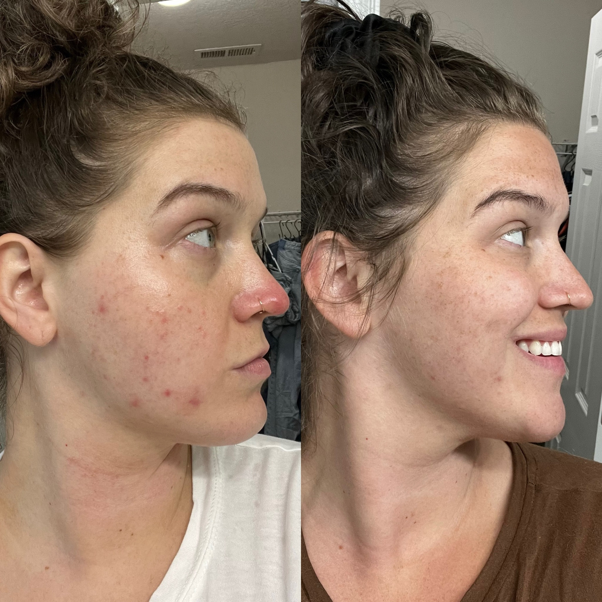 Skincare update ‼️ Left was April when my skin began to purge from starting a retinoid differin gel // Right was end of June 🙌🏼 
#skincare #beautyproducts #acneprone #differingel #retinoid #affordableskincare #musthaves

#LTKbeauty #LTKFind #LTKunder50