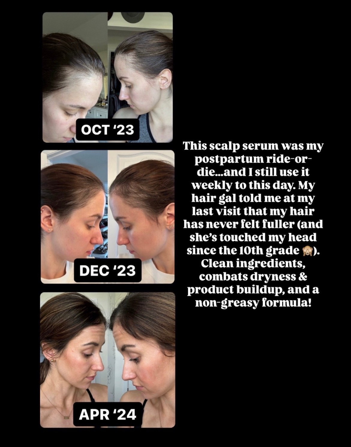 This non greasy scalp serum has done WONDERS for my hair postpartum! 

#LTKBeauty #LTKmorningroutine #LTKmomlife