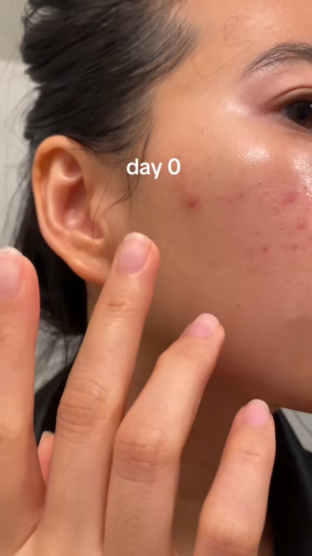 my acne life saver! Vichy acbe spot treatment is one of the best I’ve tried and it doesn’t dry out my skin. 

How to use: after moisturizer. 

#LTKBeauty #LTKmorningroutine #LTKselfcare