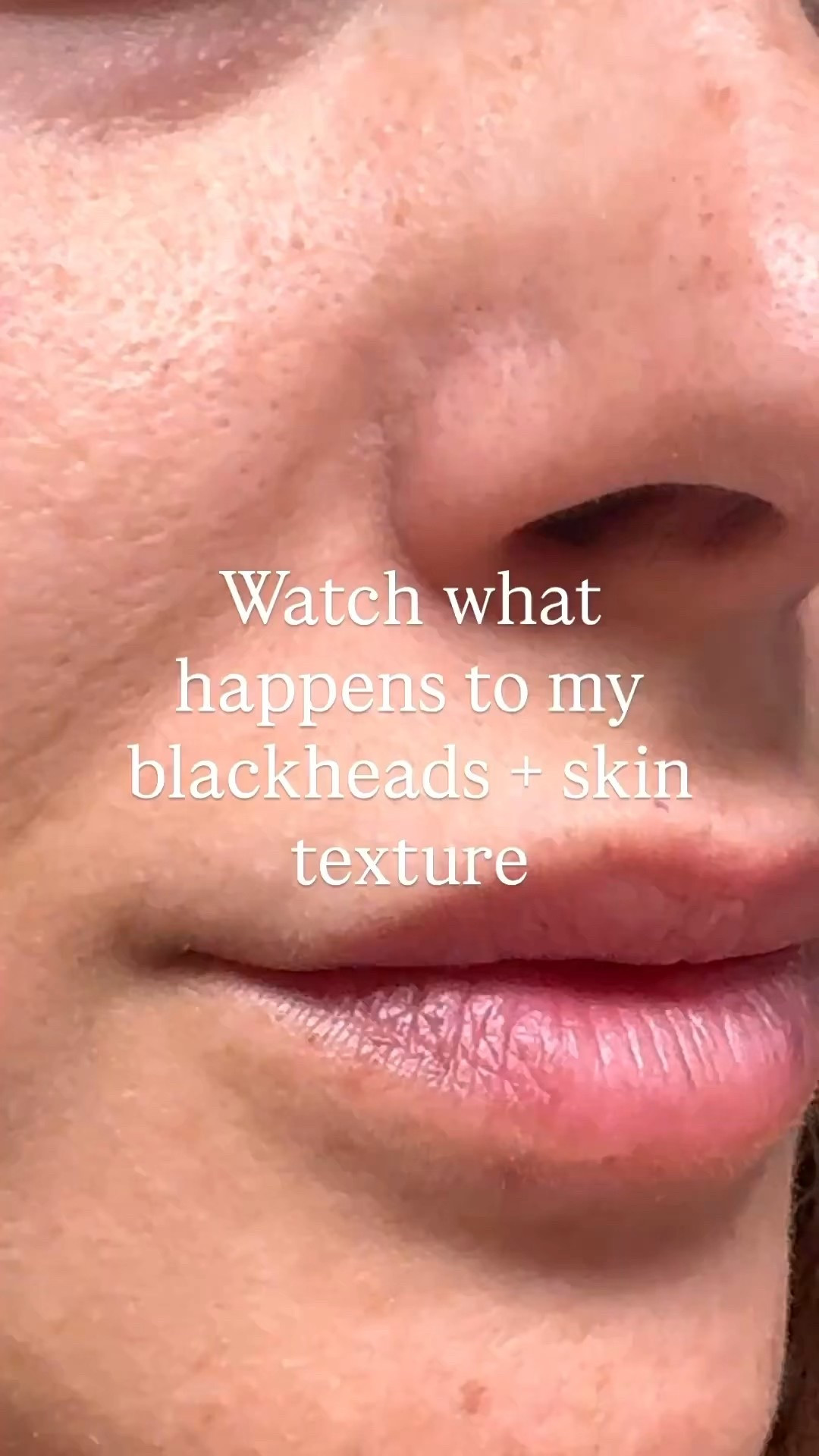 Ok so I did a little experiment for science 🤓 … I didn’t use these toner pads for over a week to see how my skin would look. The before is what it looks like without using them for a bit. The after is one use, so imagine what my skin normally looks like when I use them consistently 🤩 

I’m linking absolute fav, tried and true toner pads that I’ve re-ordered for months now. I genuinely haven’t tried anything better that is as cost effective and actually works!! I also bought these for my friend and she’s already seeing results after a few uses too! 

Brighter clarity, smoother skin texture, deeper hydration, clear pores + less blackheads…WINNING!👏🏽 I mix Korean skincare with waterless and it’s literally a dream. Comment SKIN if you want the rest of my routine too 💦 ✨ 

For reference…I’m 38 with an autoimmune disease that dries out the skin, and hormonal imbalances which also has affected my skin. So to combat all of that and still get the benefits really tells you a lot about the quality of my skincare. (Plus diet and lifestyle helps too)


#skincare #koreanskincare #waterless #agingskin #antiaging #agegracefully 

#LTKBeauty #LTKFindsUnder50 #LTKU