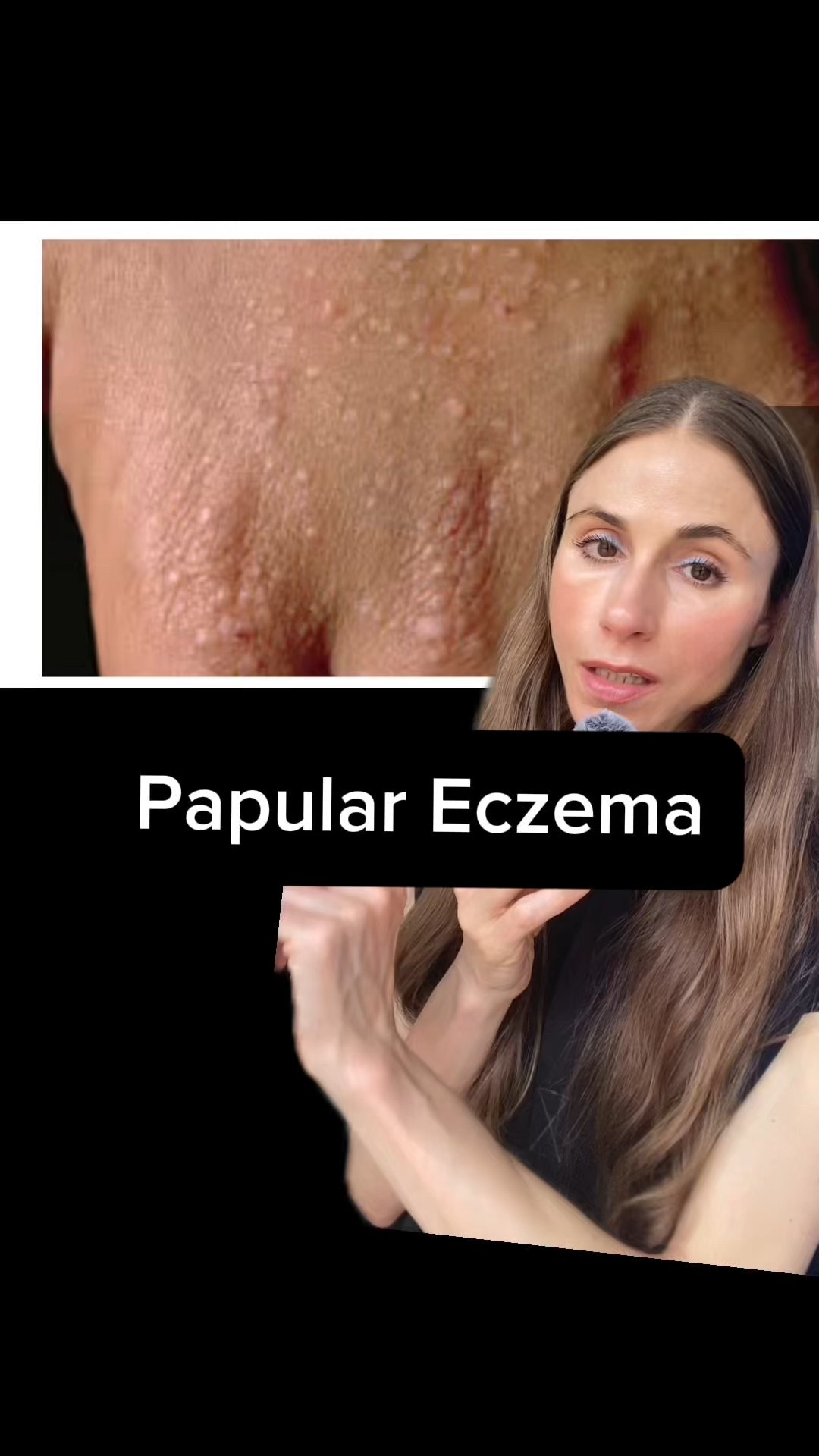 Papular Eczema Explained  

#LTKBeauty