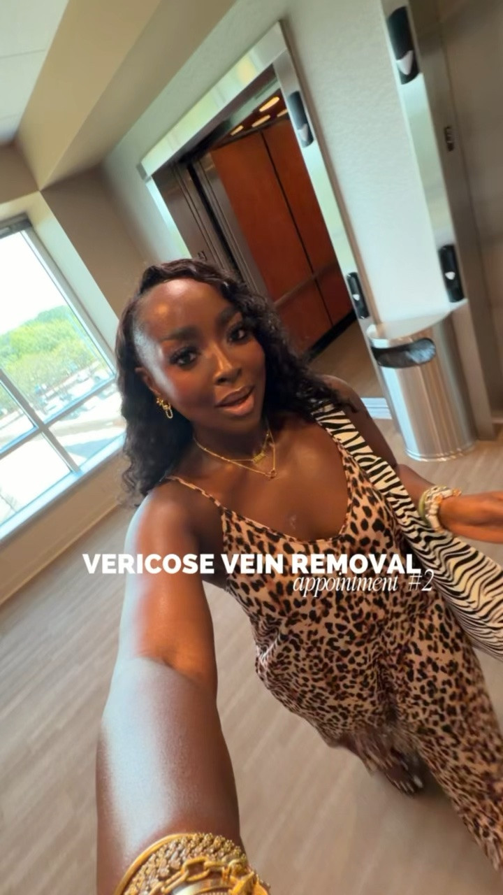 Finally on round two of #Sclerotherapy for #VericoseVeins and I’m glad I got to treat both legs at once. Now I have to work on lightning hyperpigmentation that is a result of the bruises. We’re getting somewhere! #VeinTreatment #SpiderVeins #beautytreatments