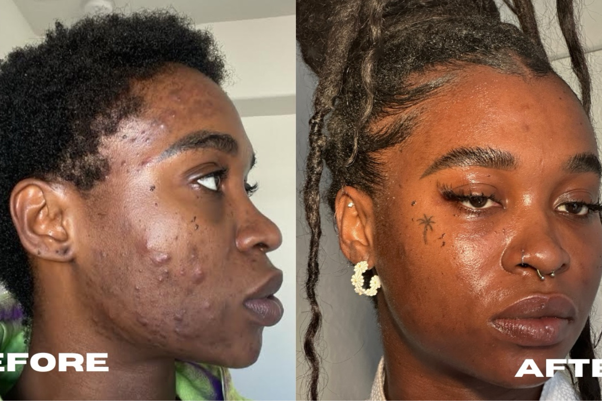 How I got ride of my hormonal acne. Steps below. Most of this products are in target & Sephora! 
Face wash: Kiehl’s ultra facial cleanser
Exfoliates: Paul’s choice exfoliate 
Moisturizer: Clique moisturizing gel
Rose water : Mario Badescu  


#Skincarejourney #acne #budgetfriendly #skincareroutine 

#LTKbeauty