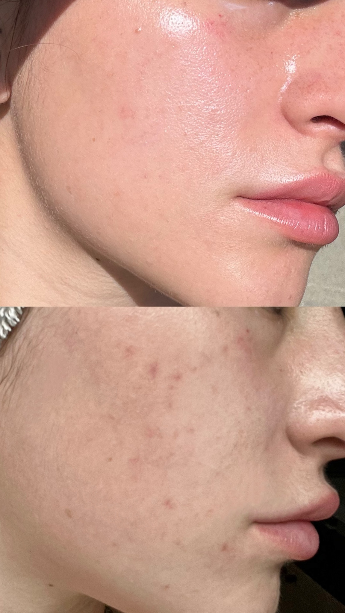 How I took my skin from the bottom photo to the top photo 

#LTKbeauty #LTKfindsunder100 #LTKfindsunder50