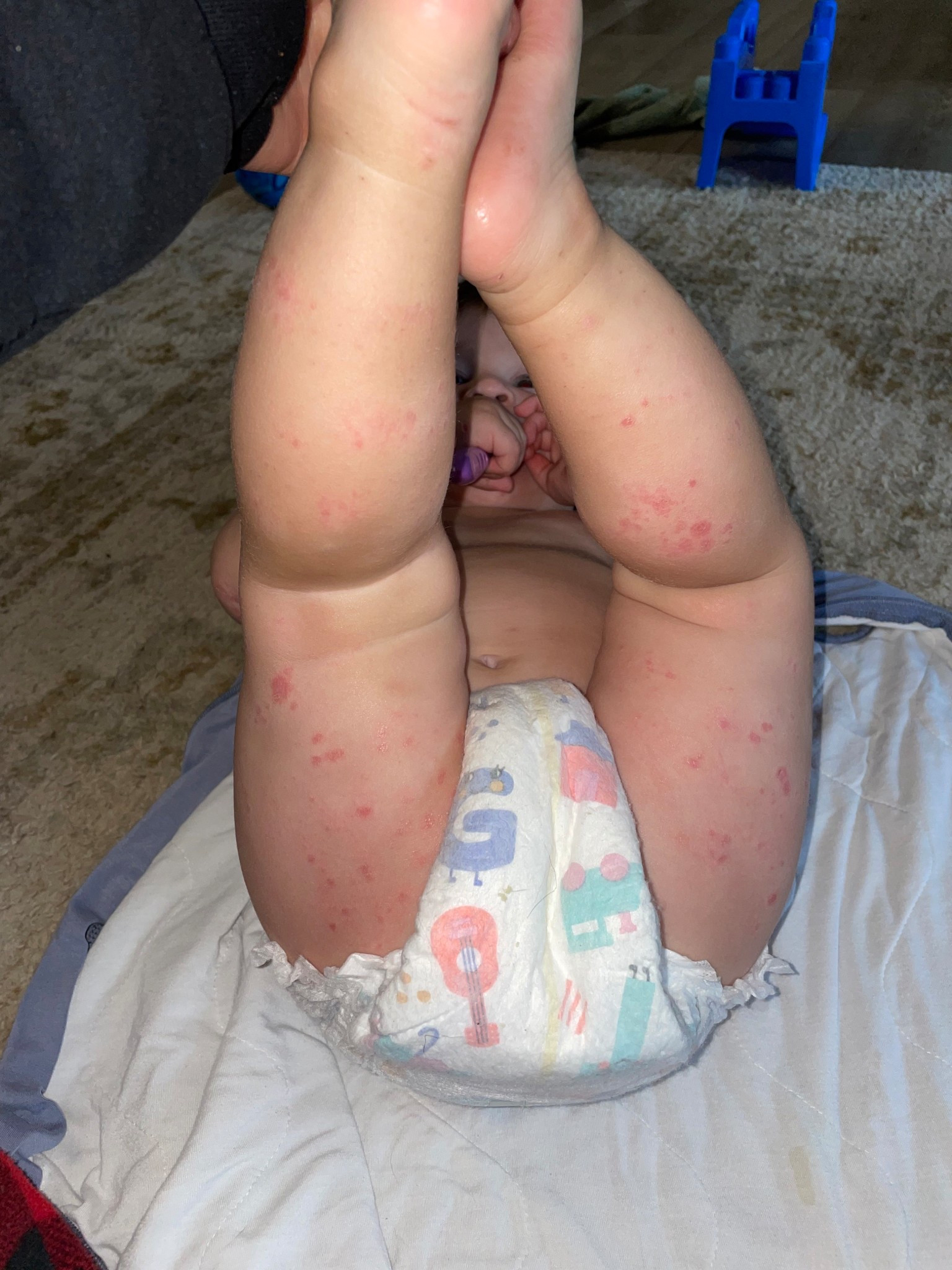 Hand foot mouth disease on my youngest 💔 I wish I could show you the before in the same pic!! This cream has helped him heal SO MUCH in just a few days!! Highly recommend!! 

#LTKFamily #LTKBaby #LTKKids