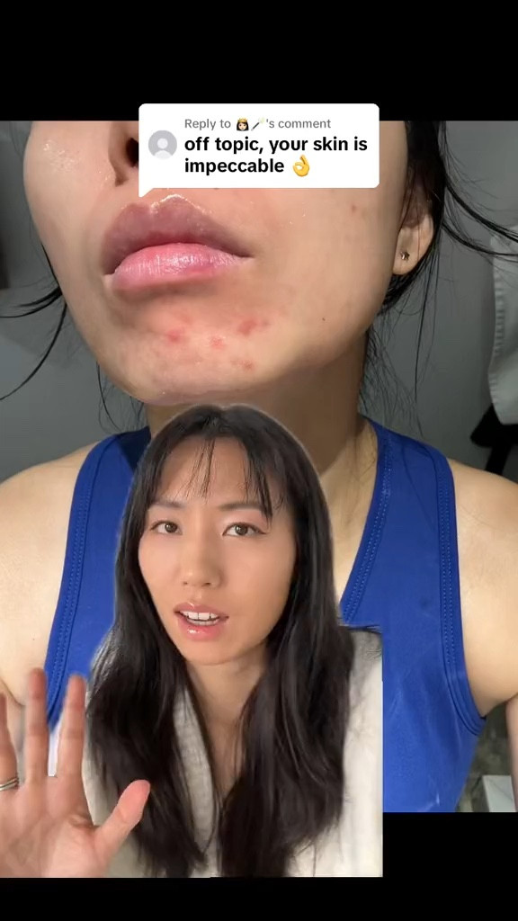 How to get of acne FAST

#LTKbeauty