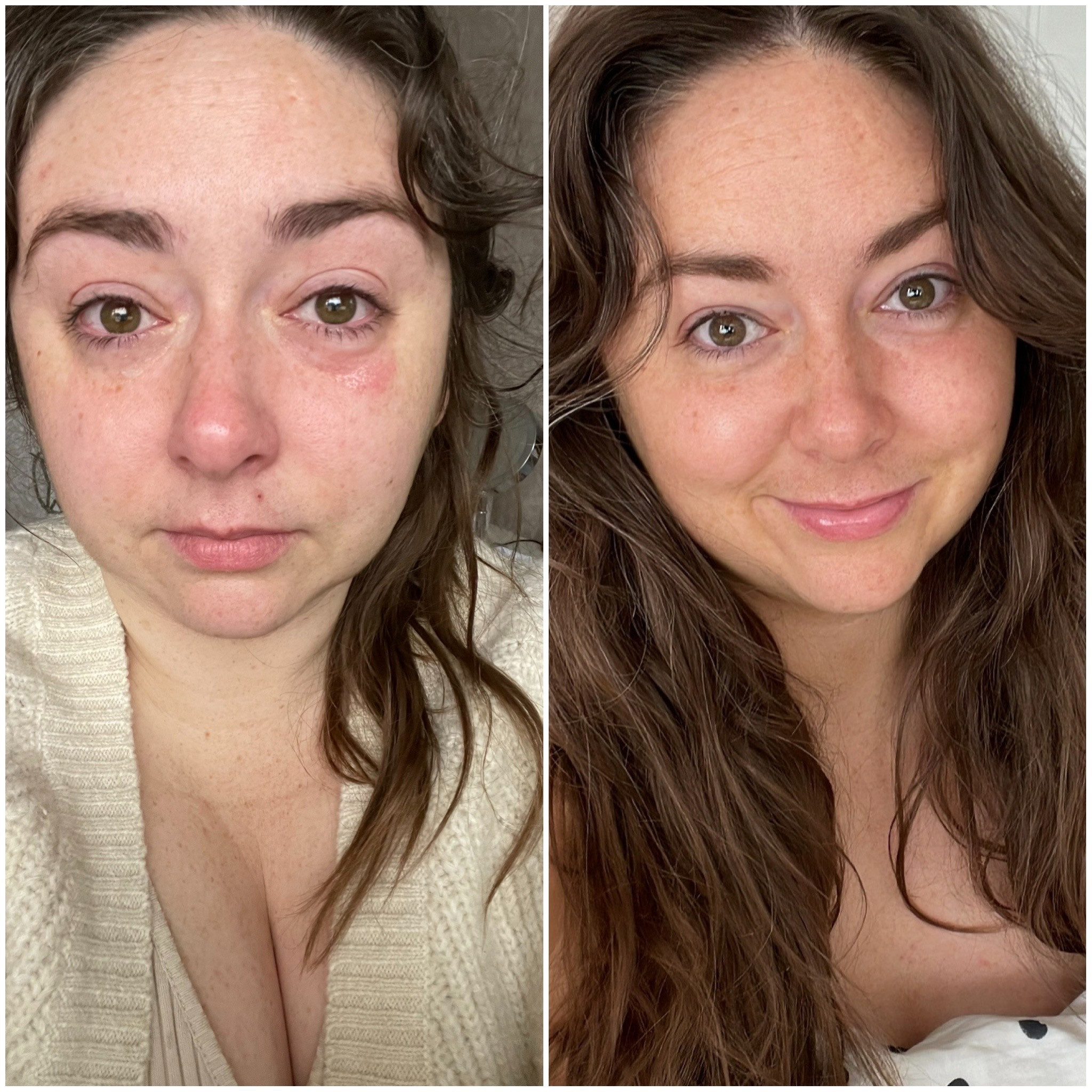 Oh face eczema, you’re so fun! I get it when I’m super stressed, and I started using La Roche Posay Cicaplast and it literally worked overnight for me: these pics were a few days apart! I’ve linked a few more products that came highly recommended from you all too because it’s really important to remember that not everything works for everyone’s skin 💖 I also used CeraVe moisturising cream for the rest of my face too and it so helped. Good luck my gals 💖

#LTKeurope #LTKfindsunder100 #LTKplussize