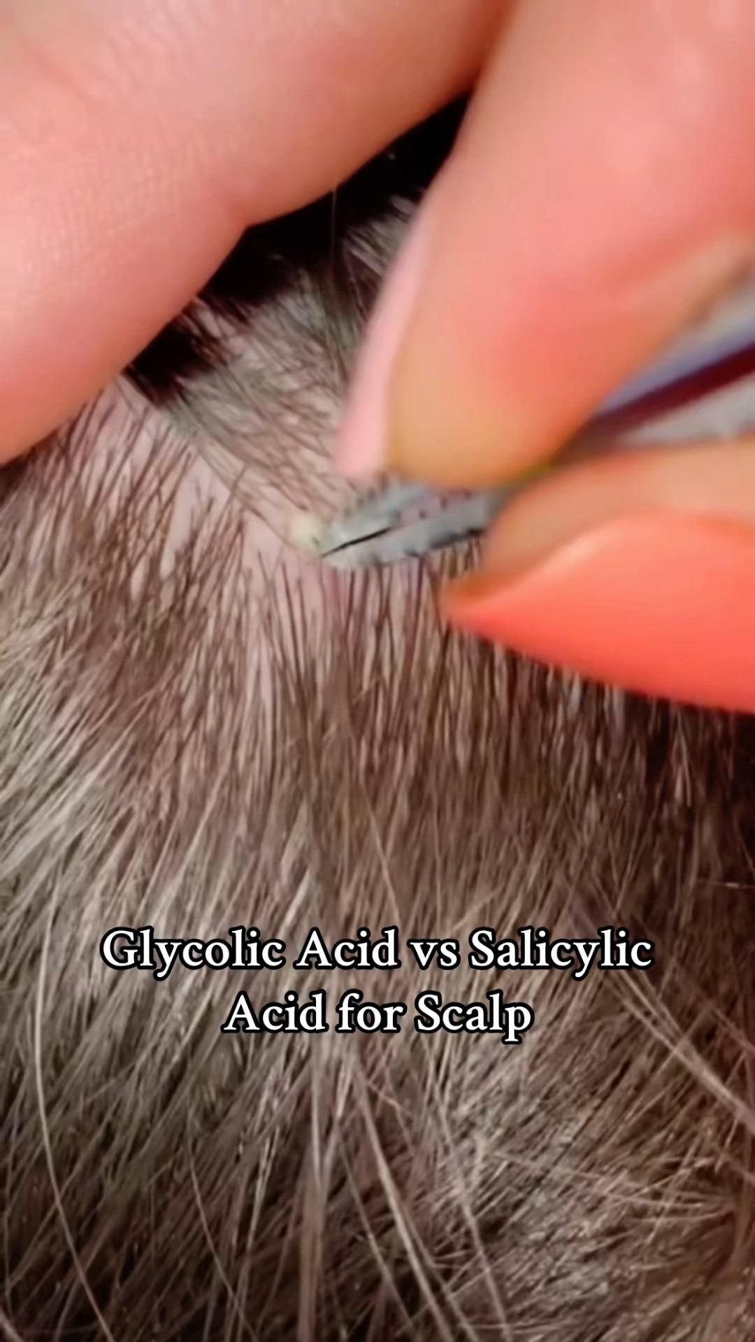 Glycolic Acid vs Salicylic Acid for scalp 

#LTKVideo #LTKxPrimeDay