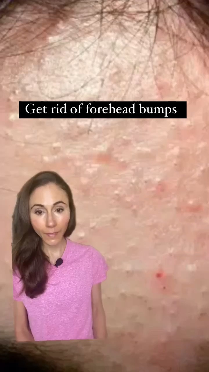 Skincare routine for closed comedones with CeraVe acne control wash & Differin gel. 

#LTKfindsunder50 #LTKU #LTKbeauty