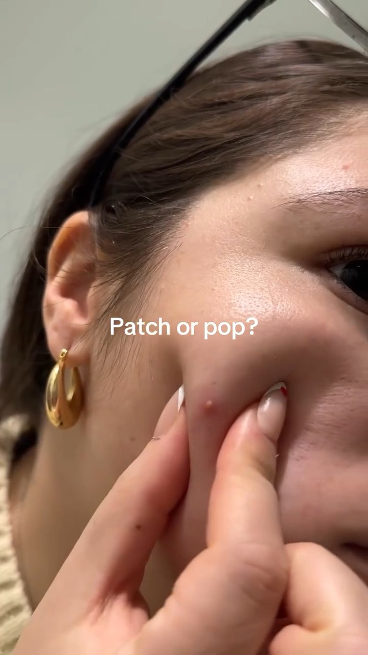 THIS PIMPLE ITCHES SO BAD😝 idk why but the last few I’ve had are UNBEARABLY itchy and it’s always when I’m traveling 

Anywho @get_rael have coincidentally been the patches I bring on trips so let’s see how they cook tomorrow 🤝

#pimplepopping #pimplepatch #pimplepatches #acnetreatment #acnejourney

#LTKselfcare #LTKgrwm #LTKBeauty