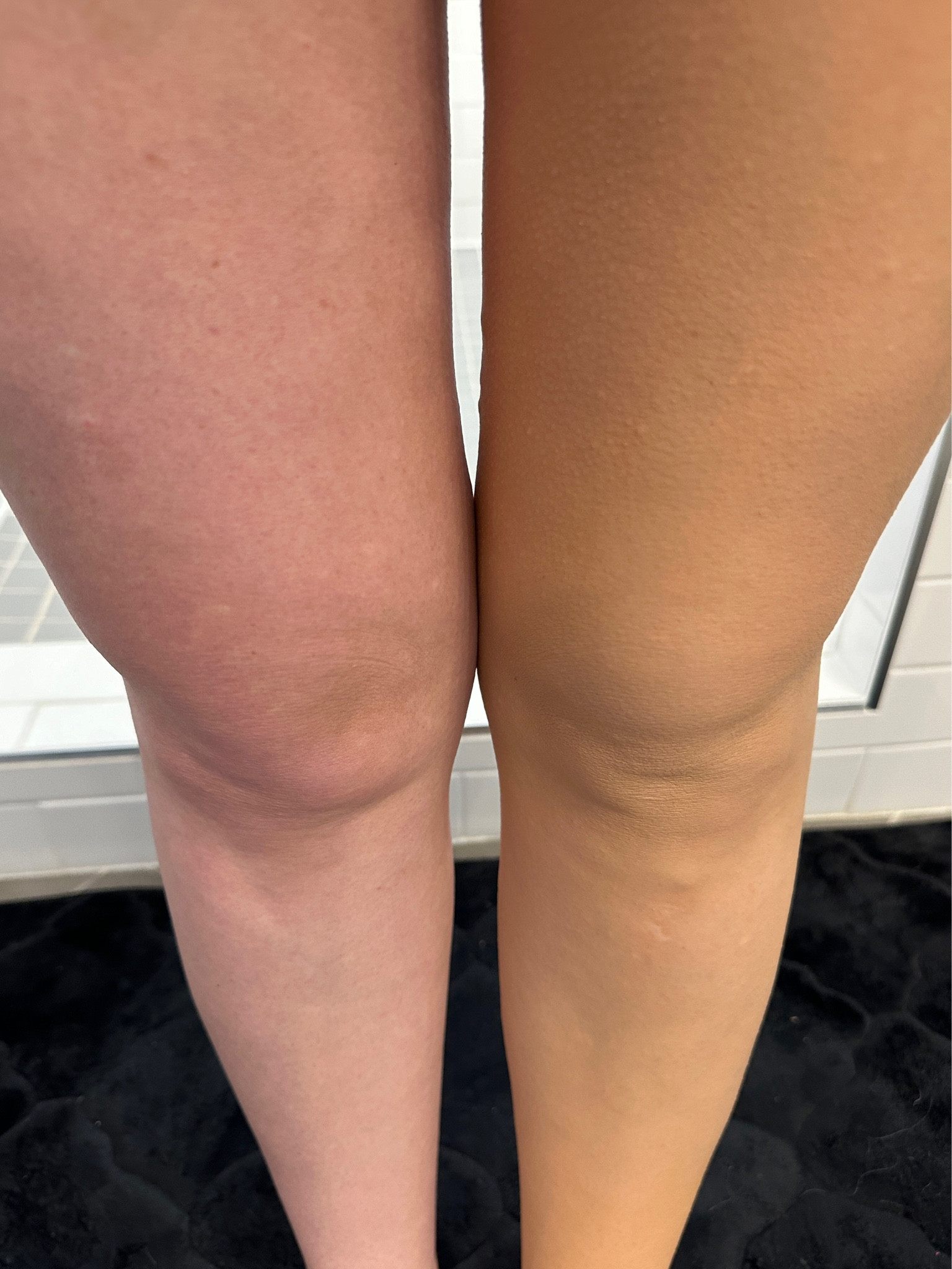 Before and after applying this body makeup to my legs. Unbelievable results

#LTKStyleTip #LTKFindsUnder50 #LTKBeauty