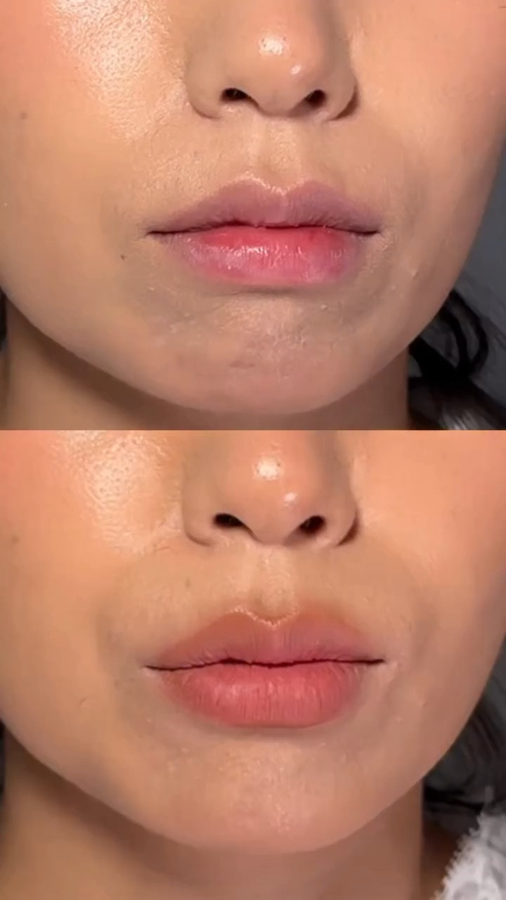 Don’t use this tutorial unless you want lip filler allegations 😬