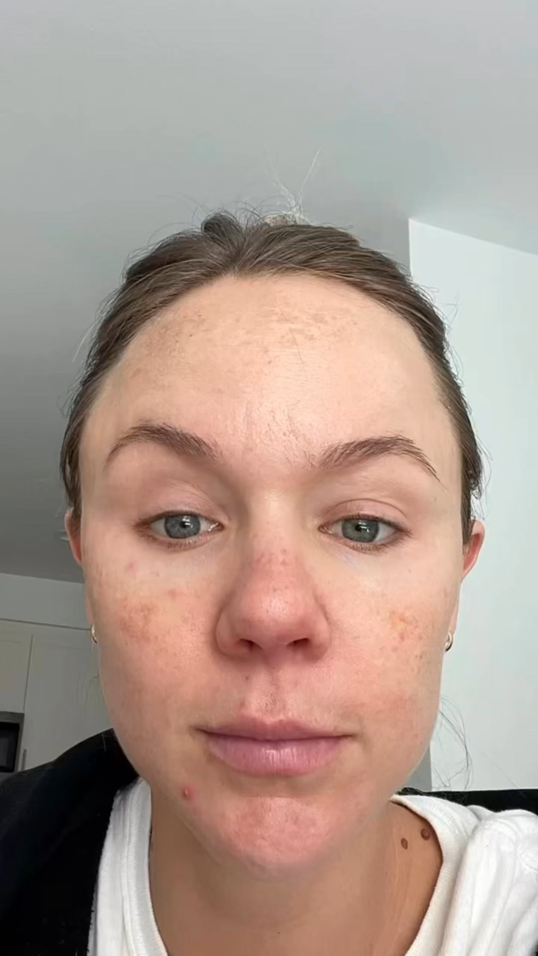 Daily practices 
Sun protection: I use Clearstream SPF 50 every single day even when I’m inside plus a physical barrier of a wide brim visor/hat whenever I’m outdoors 

Vitamin C: I use Clearstrem Clearity serum to clear pigmentation & protect skin from new pigment every AM 

Retinol alt: I use the Clearstem Hydraglow moisturizer to increase cell turnover & promote collagen/elastin to clear pigmentation every PM 

Treatments 
I do a series of microneedling with PRP yearly to fade pigmentation & other signs of aging like enlarged pores, wrinkles, & skin laxity 


#LTKU #LTKBeauty