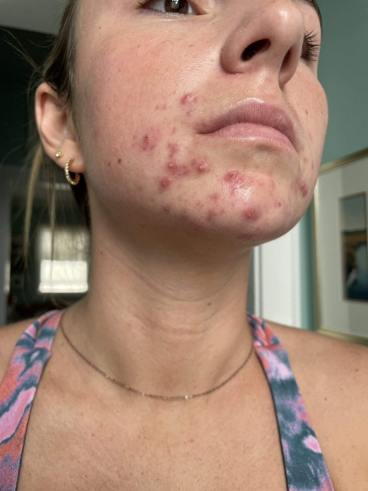 Hormonal acne before and after finding products that actually make a difference! Tretinoin did not work for me but the Inkey List and Hero Cosmetics have TRANSFORMED my skin!!!

#LTKMostLoved #LTKfindsunder100 #LTKbeauty