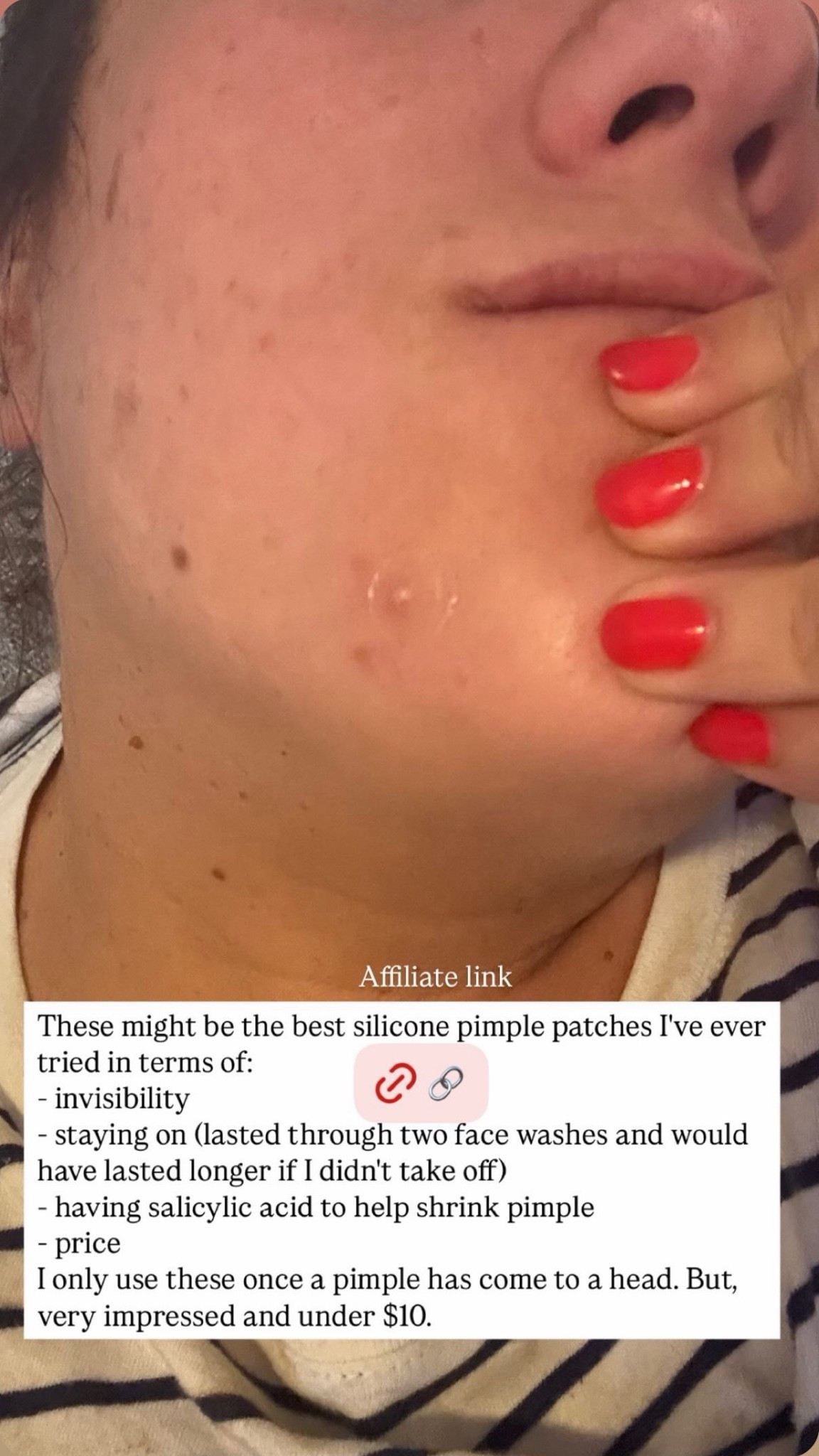 The INKEY List hydrocolloid pimple patches continue to be my favorite pimple covers. The salicylic acid formula really works to shrink pimples, and they’re thin, hard to detect, and actually STAY on. Like, this one stayed on for three days through multiple face washes and showers. Oh yeah, and they’re under $10.

#LTKBeauty #LTKselfcare