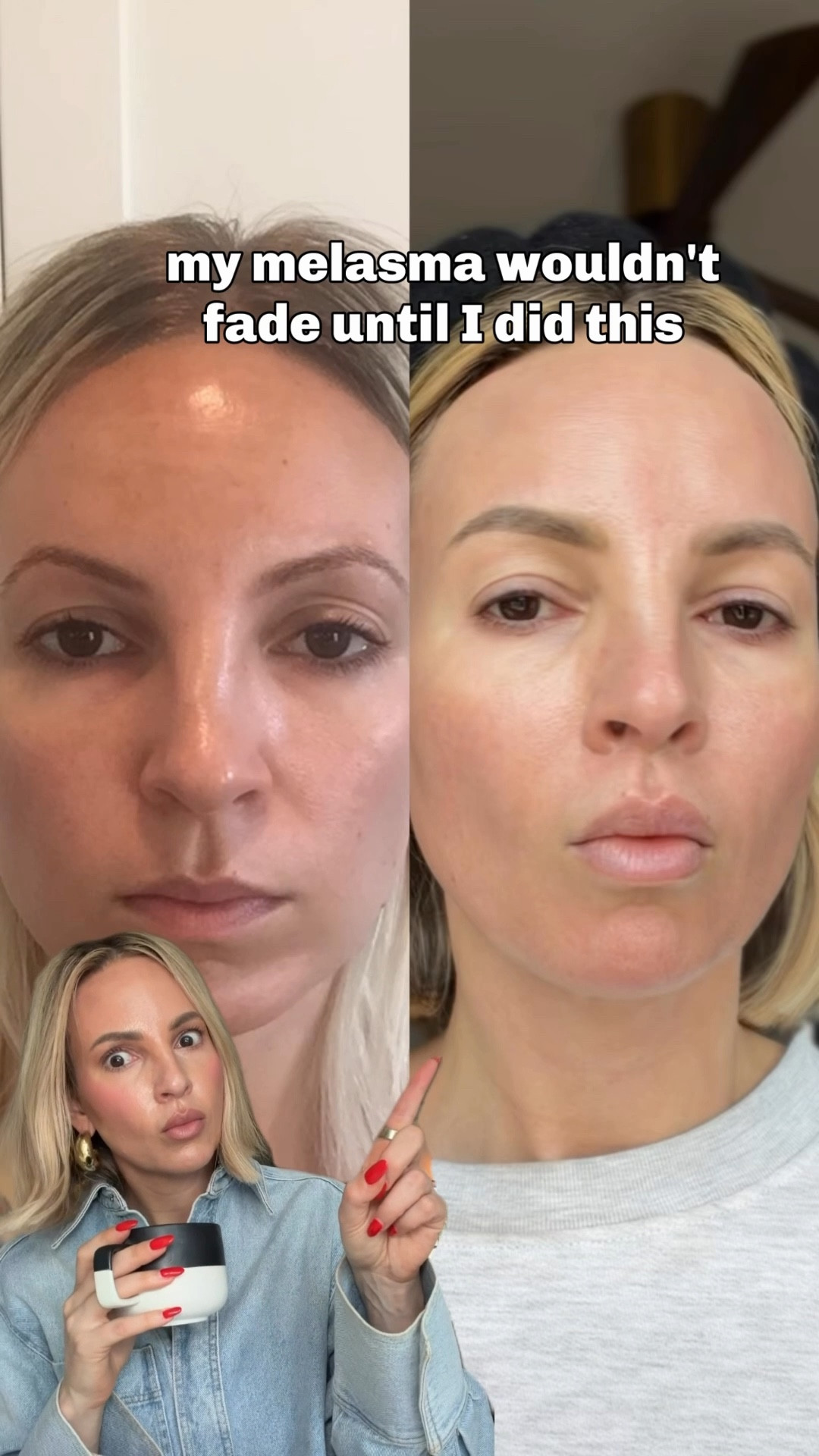 Melasma is incredibly stubborn, but these are the three categories that made the biggest difference for me.

1. Never letting this son hit my face￼
Melasma isn’t just triggered by UV — it’s also triggered by visible light. That’s why dermatologists often recommend tinted mineral sunscreens with zinc oxide and iron oxides. They help block both UV and visible light, which is key if you’re trying to prevent melasma from coming back. Consistent sun protection is really the foundation. I also don’t open the sunroof in my car and I always wear a hat or visor when I’m in the sun. I also got the UV film protection on my car windows (linked my favorite hats )￼ 

2. Pigment-fading creams
The Obagi hydroquinone cream is one of the most effective ways to fade existing melasma because it helps break up pigment in the skin — but you do need a prescription for it.

I also linked another Obagi cream that doesn’t require a prescription because it doesn’t contain hydroquinone. Instead, it uses arbutin, which helps slow down pigment production. It works more gradually but is a great option if you can’t get the prescription version or want something gentler for maintenance.

3. Being mindful of heat
Something a lot of people don’t realize is that heat can trigger melasma too. Things like saunas, hot yoga, or letting your face overheat in the sun can stimulate pigment. I try to keep my face protected and avoid prolonged heat exposure whenever I can.

#LTKBeauty #LTKOver40 #LTKstorytime