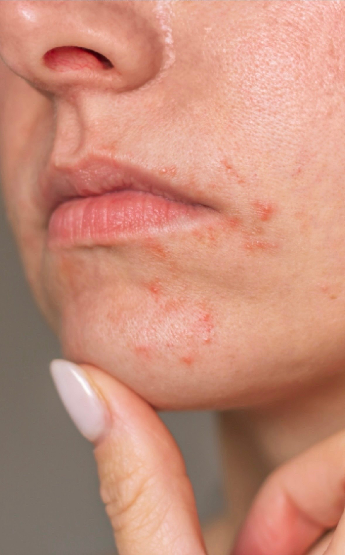Favorite products for perioral dermatitis and repairing your skin barrier! 
1. Gentles cleanser alternated with sulfur soap 
2. Non-comedogenic moisturizers targeting skin repair 
3. Pause your retinoids and other actives for now. 
4. Toothpaste swaps may be helpful for some as well 
