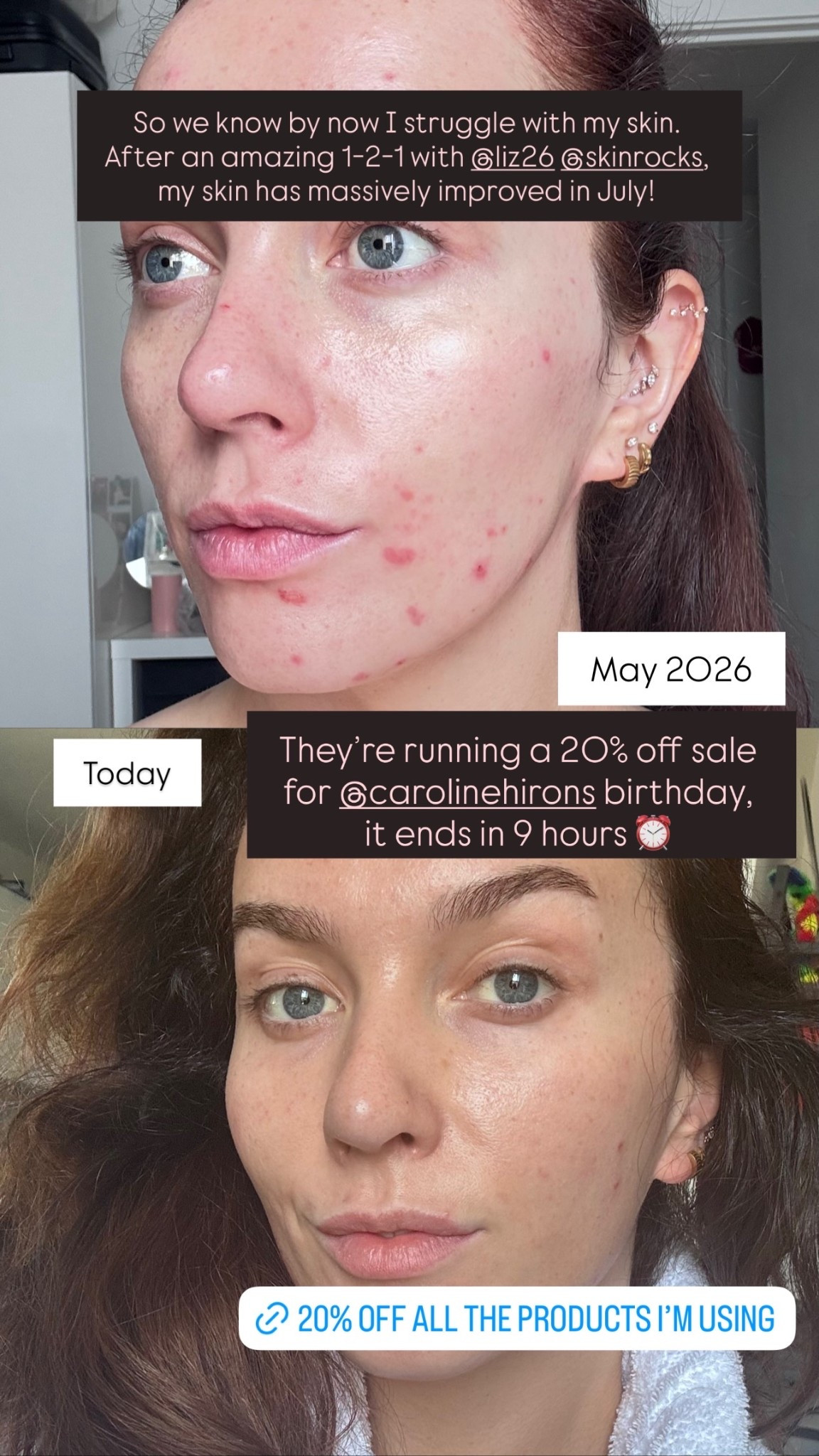 So we know by now I struggle with my skin. After an amazing 1-2-1 with @skinrocks, my skin has massively improved in July!

#LTKbeauty #LTKsummer #LTKuk