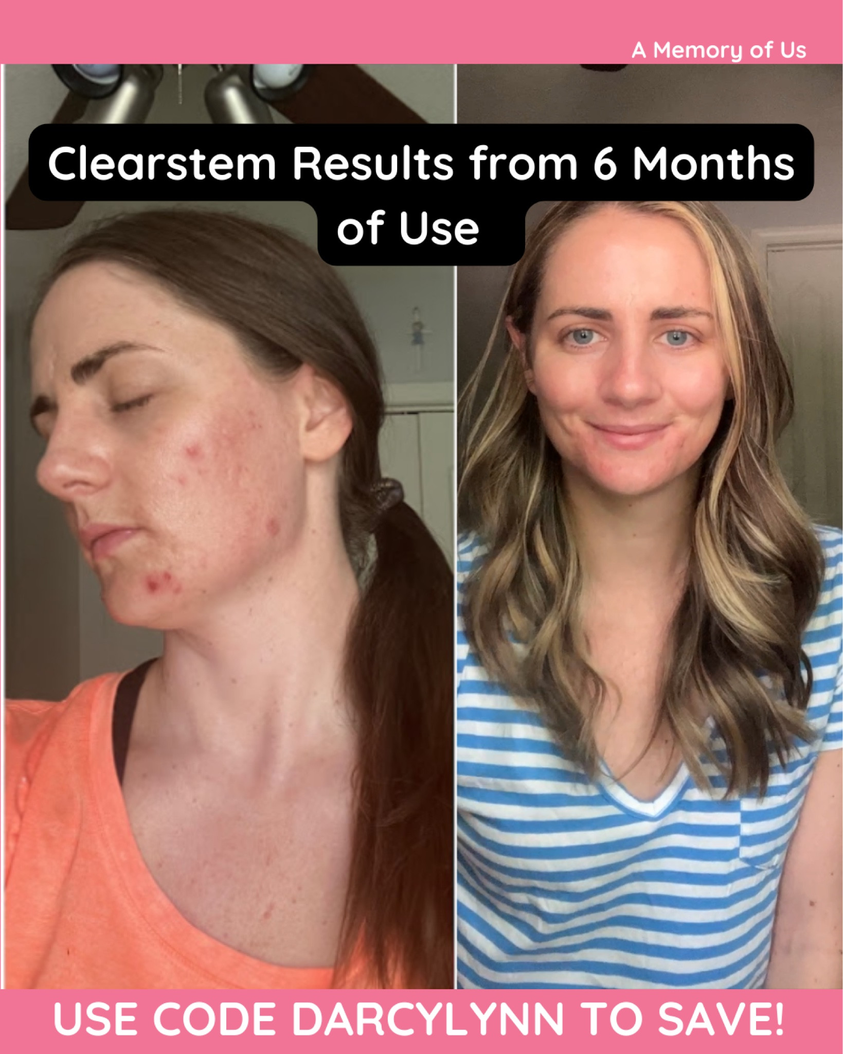Today’s  post is all about my love affair with Clearstem skincare. You can see from these pictures the difference between my skin when I first started to today. My acne has finally cleared!! This is the skincare line that finally addressed acne at the root cause and cleared my skin issues.

I have linked all the products I use from Clearstem on a daily basis to keep my skin clear.

As always, you can use my Clearstem discount code DARCYLYNN to save on your Clearstem purchase.

#LTKSaleAlert #LTKBeauty