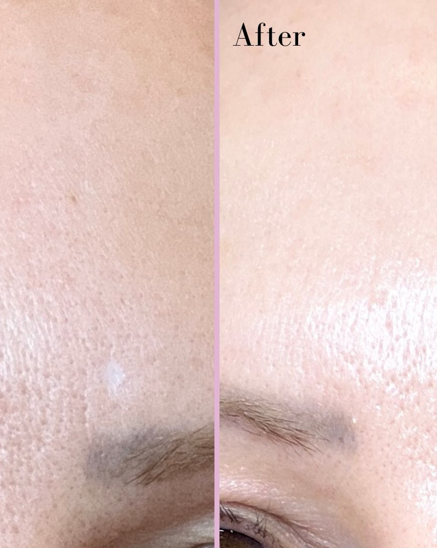 Before and after using Dr Diamond’s Metacine Plasma and Emulsion retinoid night cream. It’s definitely made my pores appear a lot smaller and helped fade hyperpigmentation. It’s pricey so even if you don’t use it year round, you could use it for 3 months for a special event like wedding skin prep. 

#LTKOver40 #LTKBeauty #LTKWedding