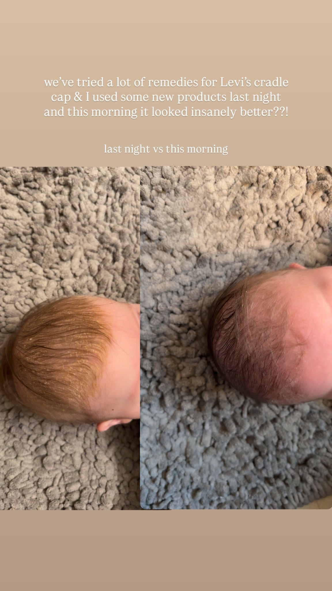 these products helped so much with cradle cap!