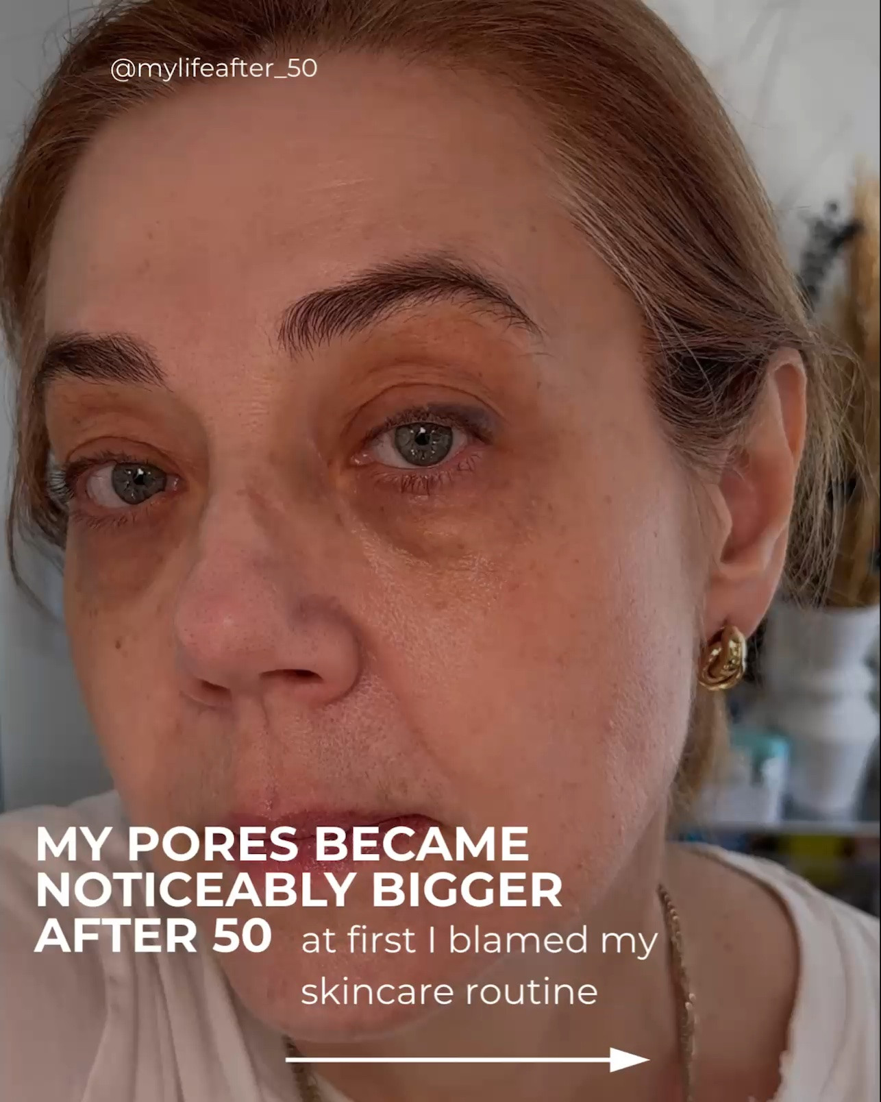 I thought my pores were getting bigger because I don’t exfoliate enough… but after 50, it’s often collagen loss that makes pores look more noticeable.

I’ve always been cautious with retinoids because most left my skin red, flaky, and irritated. Then I tried AlphaRet Overnight Cream by SkinBetter Science for 30 days.

See my before & after pictures. My pores look less noticeable, my skin texture is smoother, and my pigmentation appears more even.

Why it works: AlphaRet combines a patented retinoid with lactic acid in one formula. Together, they speed up skin renewal, gently exfoliate, and help improve texture and tone while being more tolerable than many traditional retinoids.

If you’re looking for a retinoid that’s easier on sensitive skin, this one is definitely worth considering.

From now until September 30th, you get a free set of 3 mini bestsellers ($88 value) with any purchase:
·         5ml AlphaRet Overnight Cream – Our award-winning nightly rejuvenator.
·         5ml Trio Rebalancing Moisture Treatment – For perfectly balanced hydration.
·         5ml Even Intensive Serum – To reveal a brighter, more even complexion.
This is a great opportunity to try these high-performance products.
Apply the code “BONUS” at checkout to redeem.

Save this post if enlarged pores are one of your skincare concerns after 50, and share it with a friend who needs to see it.

Follow for more easy tips on beauty and style, and lifestyle for women over 50.

#SkinAfter50 #MatureSkinCare #Retinoid #SkinBetterScience #Over50Beauty

#LTKbeauty