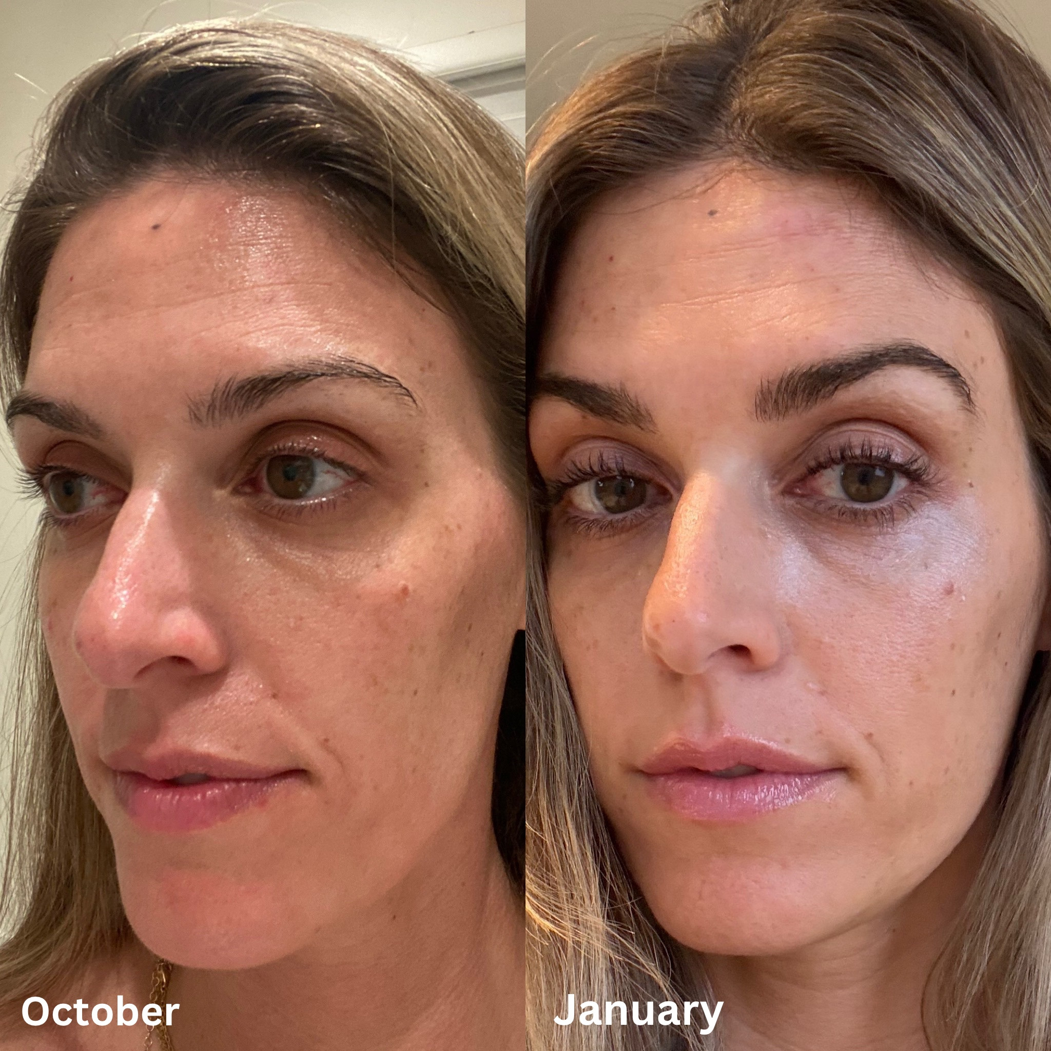 Results using the Babe Original eyelash and eyebrow serums daily for the last few months 👌 I also switched up my skincare at this time as well and it looks like my dark spots have lightened. (I’m not wearing makeup in either photo)

Babe Original, Dime Beauty, skincare, clean beauty products, eyelash serum, eyebrow serums, longer eyelashes, skincare routine, nighttime routine

#LTKFindsUnder50 #LTKFindsUnder100 #LTKBeauty