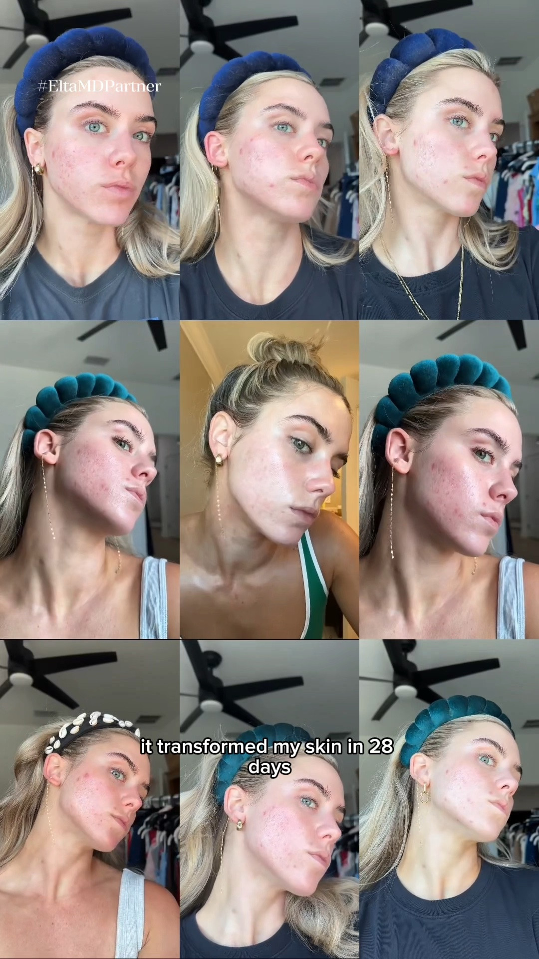 #EltaMDPartner This SPF didn't just protect my skin, it transformed my skin in just 28 days. @eltamdskincare UV Clear Blemish-Prone & Oil Balancing SPF 50 👏 An SPF that won’t irritate your skin, and helps correct the look of acne-prone skin over time, visibly reducing blemishes, oil, and pore size. Very impressed! If you have acne-prone skin, and want to level up your skincare routine, you need to try this. Shop now on my Amazon storefront.

#LTKselfcare #LTKSwim #LTKBeauty