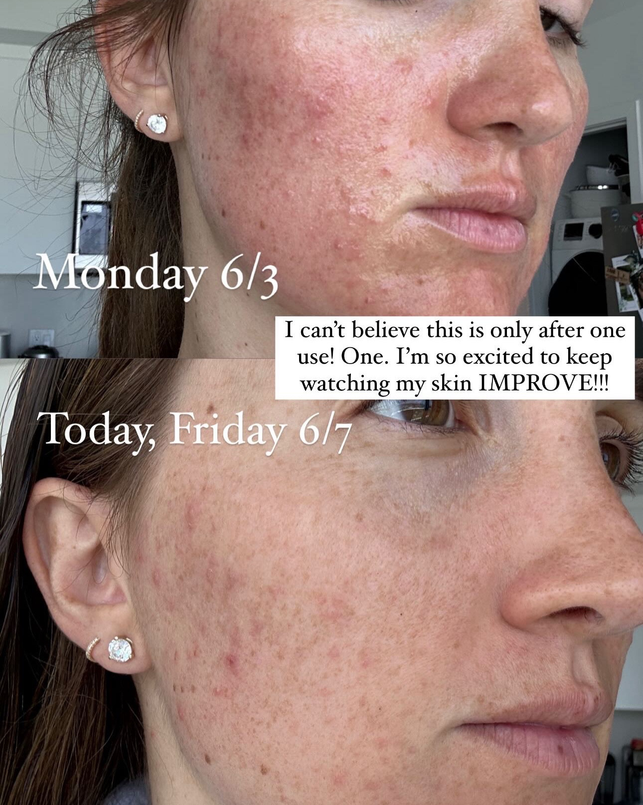 Swipe to see my hormonal acne results after 1 use of the Dr Dennis Gross LED Mask. I’ll keep documenting the progress on here. 

I’m excited to keep watching it improve and get my skin back to normal!!#LTKGiftGuide 

Use code WELCOME15 for 15% off at Dermstore (works for first time customers!!)

#LTKSeasonal #LTKBeauty