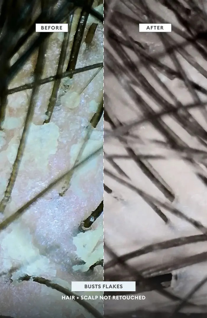 Briogeo Scalp Revival™ MegaStrength+ Dandruff Relief Shampoo Charcoal + AHA/BHA with Salicyic A... | Nordstrom