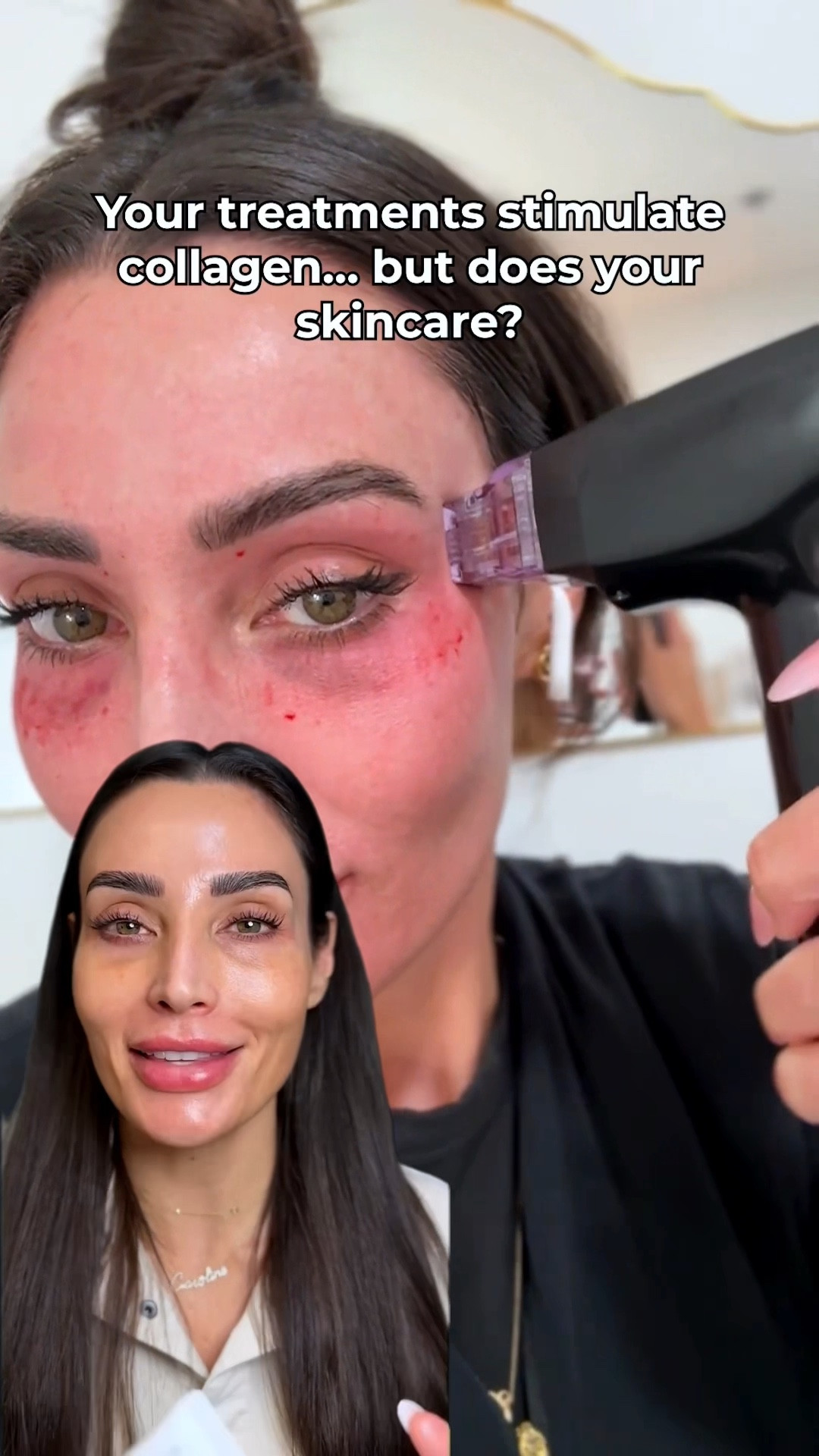 Peptides + PDRN signal your skin to repair and support collagen between treatments.

So instead of relying on in-office results alone… you’re building on them every day.

@abib.global #fillerceam #pdrn #rejuran #treatment #glassskin 

#LTKBeauty #LTKOver40 #LTKselfcare