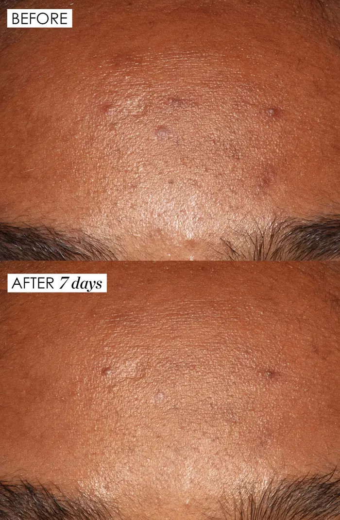 Jumbo Good Genes All-in-One Lactic Acid Exfoliating Face Treatment $284 Value | Nordstrom