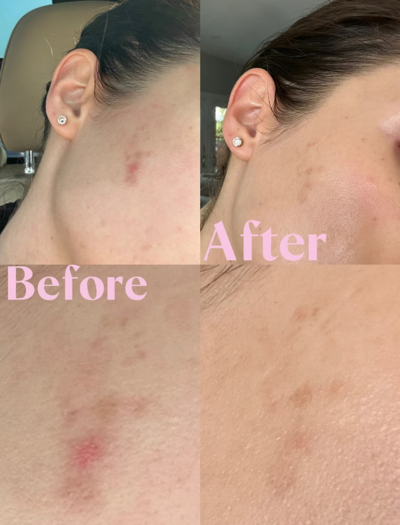 These photos are about three months apart, June 2023- now. 
 
If you’re someone that knows me personally, you know I am always talking about skincare, it is one of the million passions I have in life. I have to share this tip because I love this product and think it is really working for me. It has been a slow process but I would rather wait than spend thousands of dollars on laser treatments (which I was actually quoted) to remove these scares that I have from hormonal acne. 

Some tips from me for shedding dead skin and lightening scars while using this:
-Exfoliate twice a week using a natural exfoliant (I have a recipe for this on my page)
-Don’t expose your skin to sunlight, I wear a hat in the sun and only allow my body to tan. I use self tanner for my face. The sun will darken your scars. 
-Use a vitamin C serum 
-Wear sunscreen every day 

How to use:
Apply a small pea size amount morning & night to the problem area after cleansing your face. 

Product name is Mederma Advanced Scar Gel. 


**I am not an esthetician or skincare expert, I experiment with different products on my skin all of the time but you should check with your dermatologist or skincare provider before use. 


#LTKbeauty #LTKFind