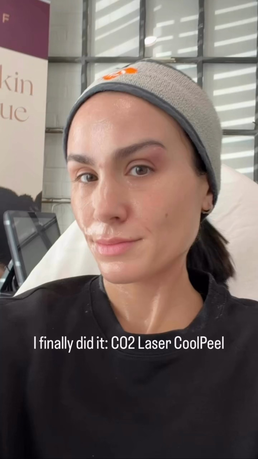 Day 1 of my skin resurrection is officially here! 

I finally went under the laser for a CO2 CoolPeel, and honestly? The anticipation was the hardest part. If you’re curious about what it’s actually like, here is the unfiltered tea:
The Vibe: Currently feeling like I spent a little too much time at the pool without SPF. I’m slightly red and a bit swollen, but it just feels like a tight sunburn. 🍎
The Sensation: Since I was numbed up, I felt basically nothing during the actual treatment—just the dull pressure of the laser tip touching my skin. The numbing took longer than the actual face and neck treatment! 🕒
The Deets: * The Sound: Exactly what you’d expect—lots of little zzzz zzzz zzzz as it works its magic. ⚡️
• The Smell: I dermaplaned a week ago (pro tip!) to minimize the smell of singed peach fuzz, so it wasn't bad at all! 🍑🚫
This is just the beginning! I’ll be sharing a day-by-day recovery diary so you can see the full transition to glass skin. Stay tuned! 🧴✨

#LTKdayinmylife #LTKselfcare #LTKBeauty