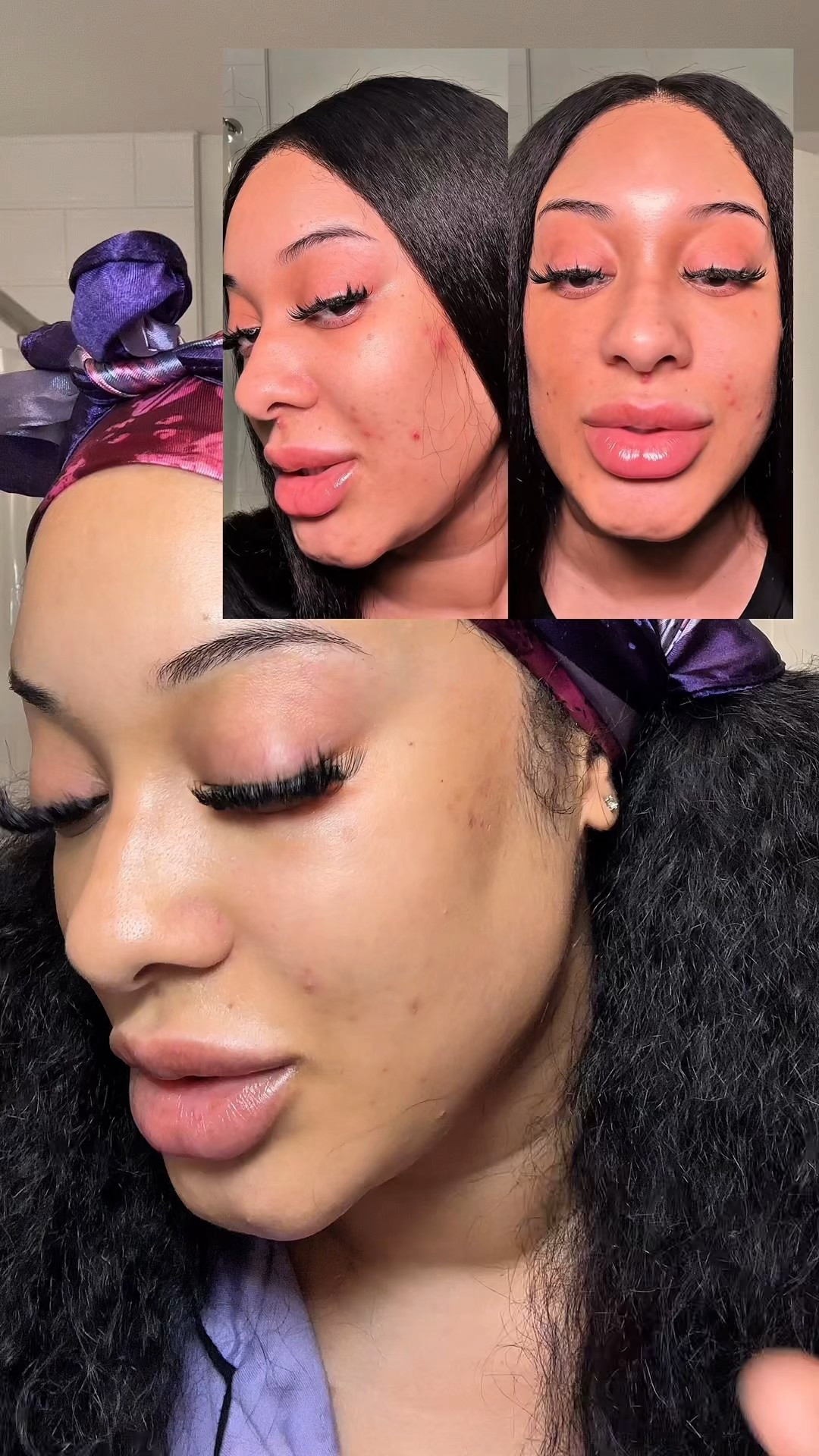 Month and a half progress with permanently removing my dark spots!

#LTKFindsUnder50 #LTKBeauty #LTKFindsUnder100