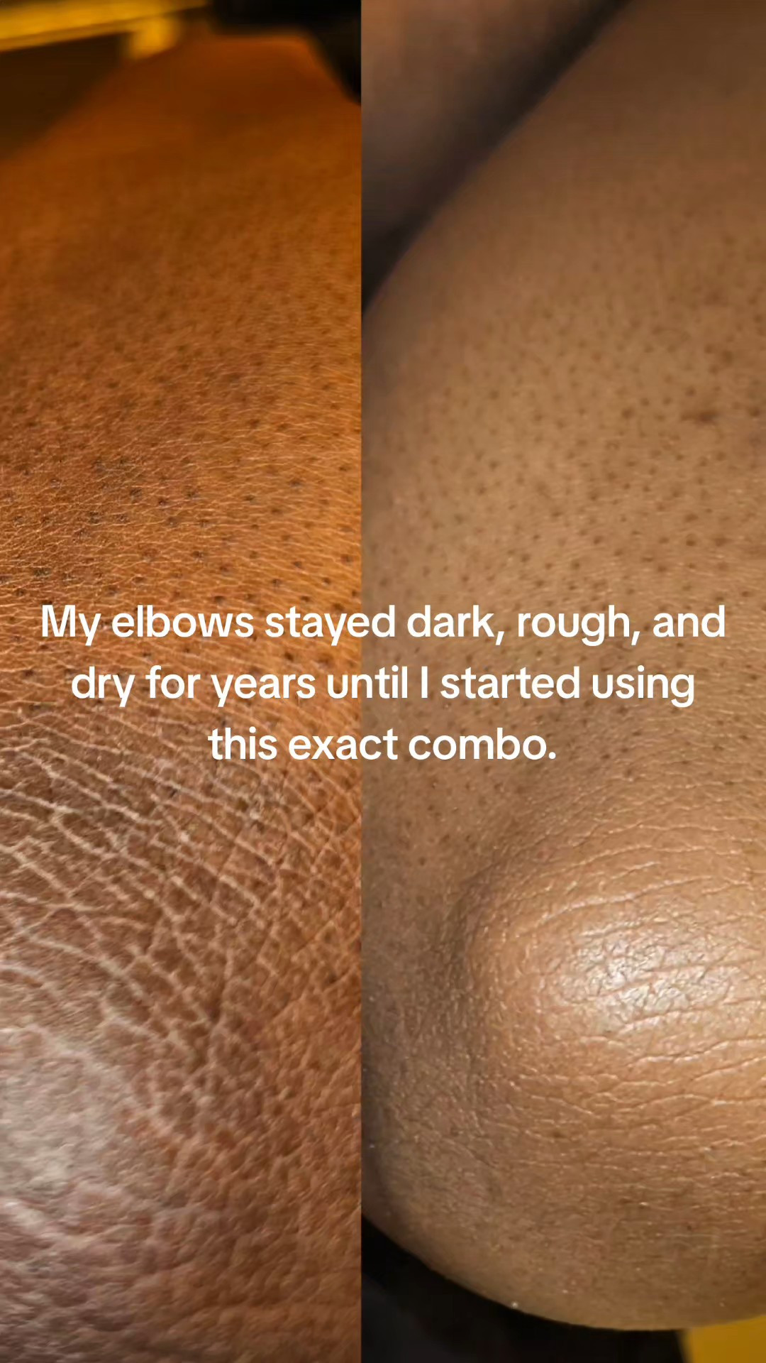 My elbows were dark, rough, and dry for years. This is the combo that finally changed how they look. Gentle exfoliation in the morning, corrective exfoliation at night. Same routine, every day. Over time, the texture softened, the dryness calmed down, and the tone started to look more even. No filters. No instant miracle. Just consistency. If you see the orange cart above, both are still available. Can’t say I never put you on....dark elbows routine, rough elbows care, exfoliating body wash, chemical exfoliation body, aha bha pha body wash, body care routine, elbow discoloration help, dry skin routine, textured skin care, smooth skin routine, body exfoliation routine, morning night body routine, tiktok shop body care, viral body wash, skincare for elbows, elbow appearance routine, body wash for rough skin, gentle exfoliation body, corrective exfoliation routine, body care tiktok, viral skincare routine, tiktok shop finds body, affordable body care, consistent skincare routine, body care transformation, even looking skin tone, dry rough elbows, elbow skincare routine, skincare content creator, bahamian creator skincare, austin influencer skincare, ugc skincare content, fall skincare routine, winter body care routine, body care deals, tiktok shop jump start sale, trending body care, exfoliating wash routineResults may vary. Disclaimer: Final price, discounts, and shipping may differ based on your account, available coupons, and current promotions. Always refer to the product listing for the most up-to-date offers. Promotion may have ended by the time you see this.

#LTKBeauty #LTKselfcare #LTKPlusSize