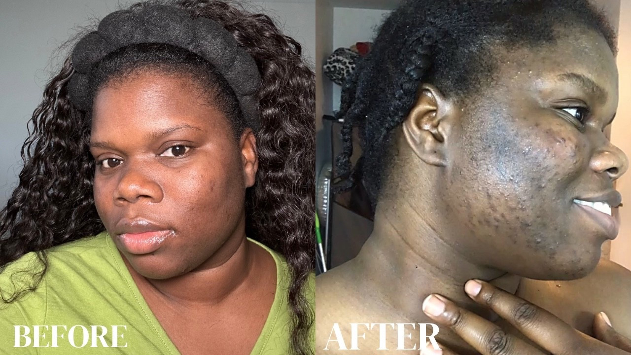 Acne 

#LTKBeauty #LTKU