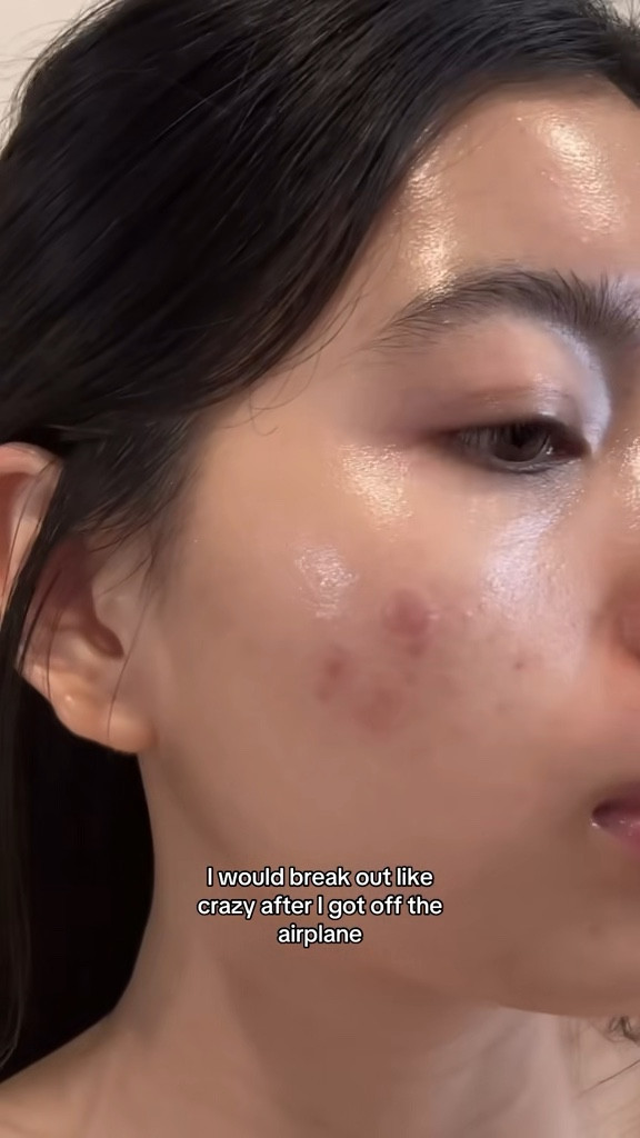 hypochlorous acid is life saver when you’re going through breakout and traveling! I’d use it on dry skin and let it dry completely before applying another product. Don’t use it vit C! 

#LTKBeauty #LTKselfcare