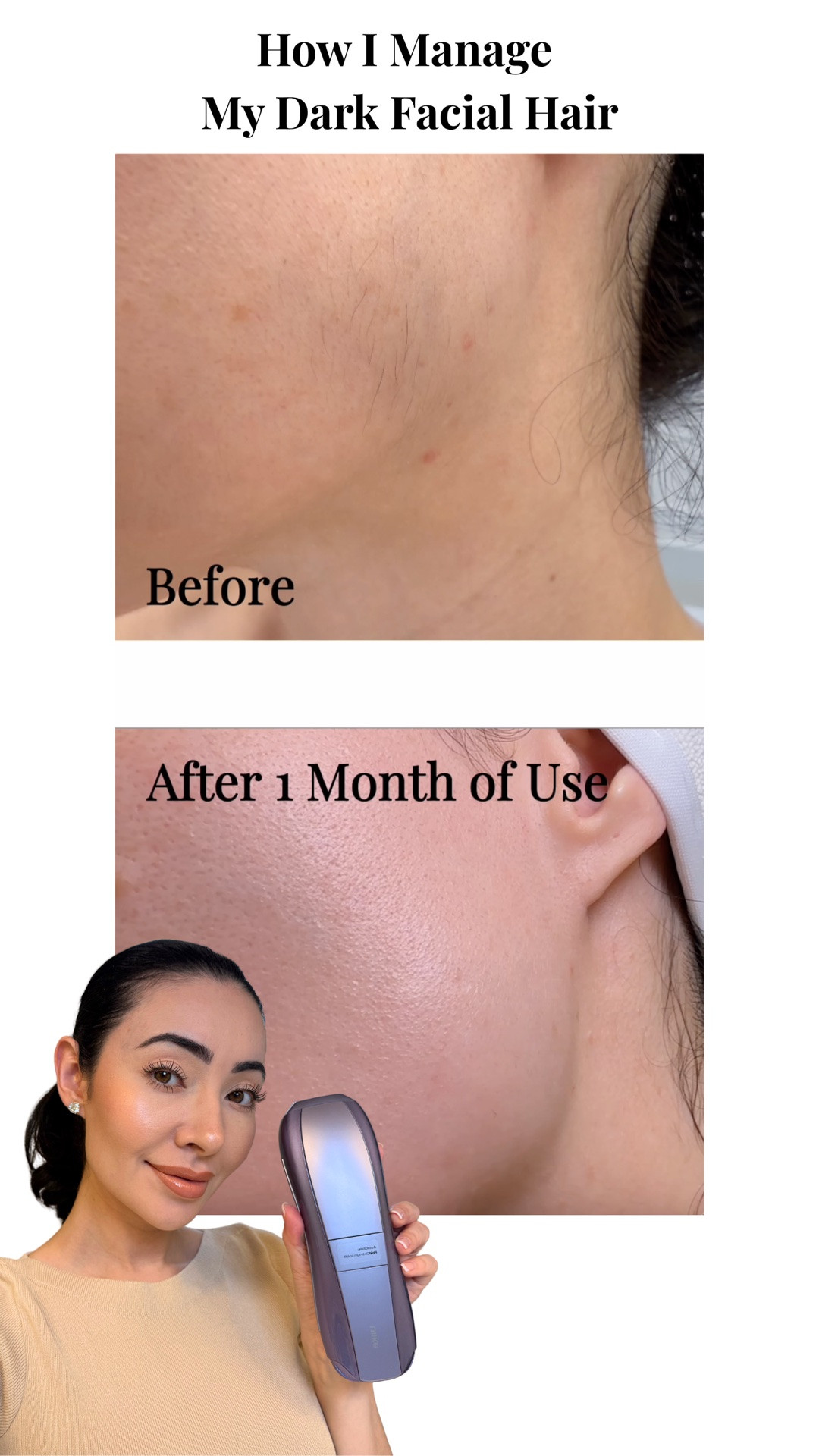 I’m ethnic, and my “peach fuzz” isn’t exactly “peachy”… Dark facial hair as a woman can be SO frustrating — and in my teens it made me really insecure. 😩

I’ve tried EVERY SINGLE METHOD of facial hair removal over the years: dermaplaning, waxing, threading… it all makes my acne-prone skin break out.

Over the past 10 years, I’ve had over 50 sessions of professional laser hair removal treatments on my face, and yet I have not been able to achieve permanent hair removal. Fun fact: facial hair is heavily driven by endocrine factors, and it is far more stubborn than body hair.

The hair removal method I’ve come to love most is the one that allows me to manage my hair removal at home. I’ve been using the Ulike Air10 IPL device. I have several other Ulike devices and I’ve always been very impressed with their build quality, warranty, and money-back guarantee. And my results speak for themselves!

🎥 p.s. If you’d like to hear more about my struggle with female facial hair and see a more in-depth review of the Ulike IPL device then check out my YouTube channel!

🛍️Comment SHOP and I’ll DM you the link, or click the link in my bio!

Use code ‘ClarissaU’ for a discount 🫶🏻

*IPL results vary by individual. Follow the manufacturer’s instructions and confirm that the device is appropriate for your skin tone and hair color before use.

#ulike #ulikehairremoval #ulikeair10 #ulikelaserhairremoval

#LTKselfcare #LTKBeauty #LTKgrwm