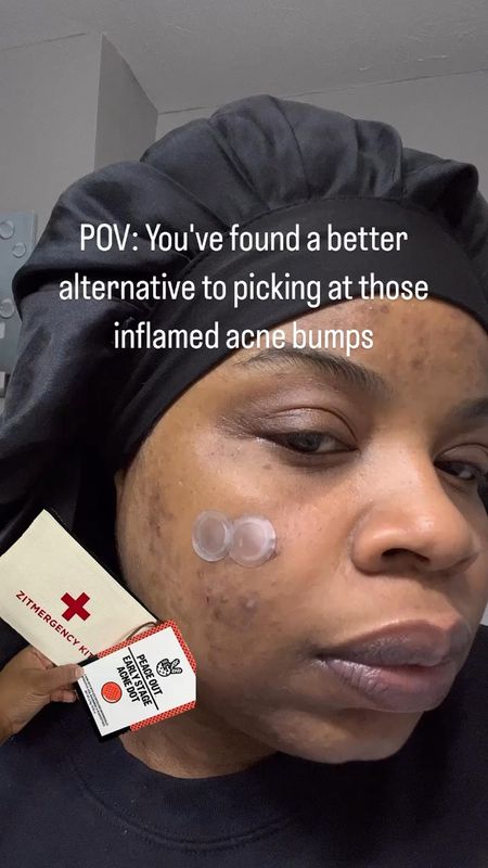 Twin! Where have you been?! 🥹 These Early Stage Acne Dots from @peaceoutskincare are 10/10, and I wish my skin found them sooner! #giftedbypeaceoutskincare 

These 2% salicylic acid medicated pimple patches has 430 self-dissolving needles with acne-fighting ingredients for those stubborn under-the-skin pimples😮‍💨

It came right on time because I had two painful ones that popped up this week, and I’ve been doing so well with not picking at my skin!! These patches reduced the inflammation so much!!🙌🏾

Check out my stories for the full before & after! 🤞🏾

Thank you again @peaceoutskincare 🫂🥰🫶🏽 #peaceoutskincare #zitmergency 

#acnepronebaddies 
#realskincare #realskin #realskintexture #realskinrealresults #acneproblems #acneproneskincare #oilyskincareroutine #acnecommunity #acnetips #acneproneskin #acnejourney #acnescars #darkmarks #skincareroutine #skincarechat

#LTKVideo #LTKMostLoved #LTKbeauty