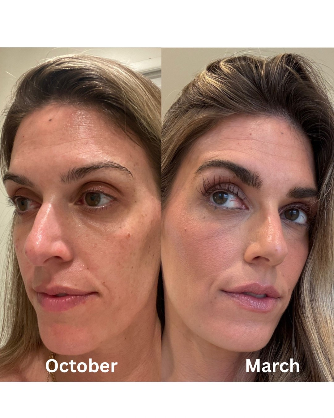 5 months using my new fave eyelash serum 👁️👌 My results have been amazing! I noticed a difference at about 4-6 weeks and here we are 5 months later and my lashes have never been longer 😍 Love the brow serum too! 

Eyelash serum, Babe Original, eyebrow serum, beauty products, makeup products, beauty must haves, beauty tutorials 

#LTKFindsUnder100 #LTKFindsUnder50 #LTKBeauty