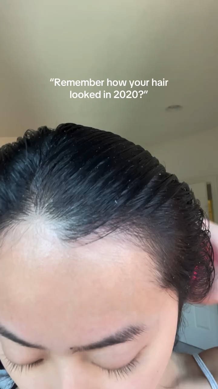 A little throwback! 😌 is anyone else still using glycolic acid for your scalp?? ;) it’s the one holy grail product that I always keep on my bathroom counter because of how useful it is! I have used it on my face, scalp, elbow, underarm, knees, legs (for my KP) and my cracked feet. Have you tried it?! 

#glycolicacid #dandruffsolution #dandrufftreatment