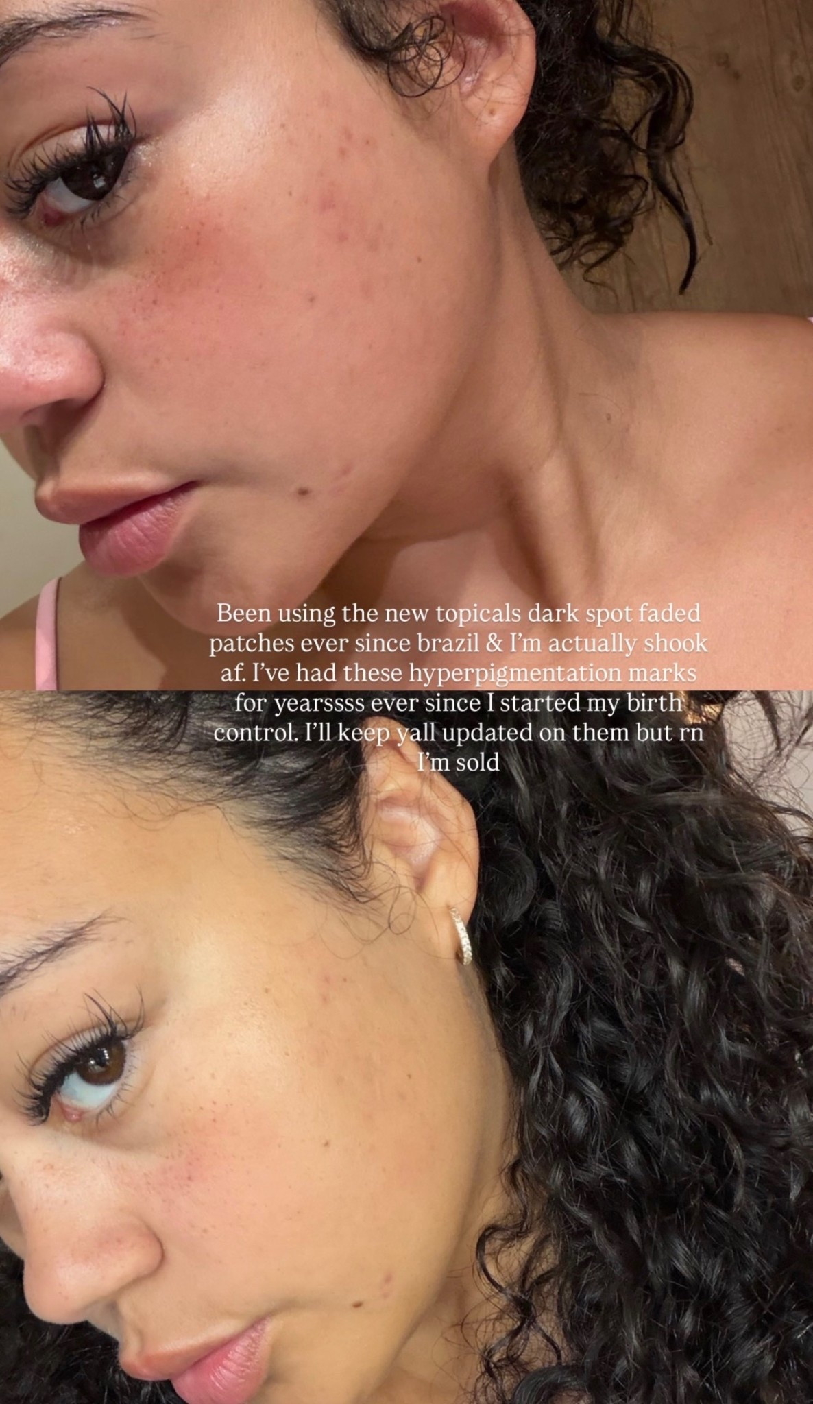 Topicals dark spot fading patches

#LTKgrwm #LTKSpringSale #LTKdayinmylife