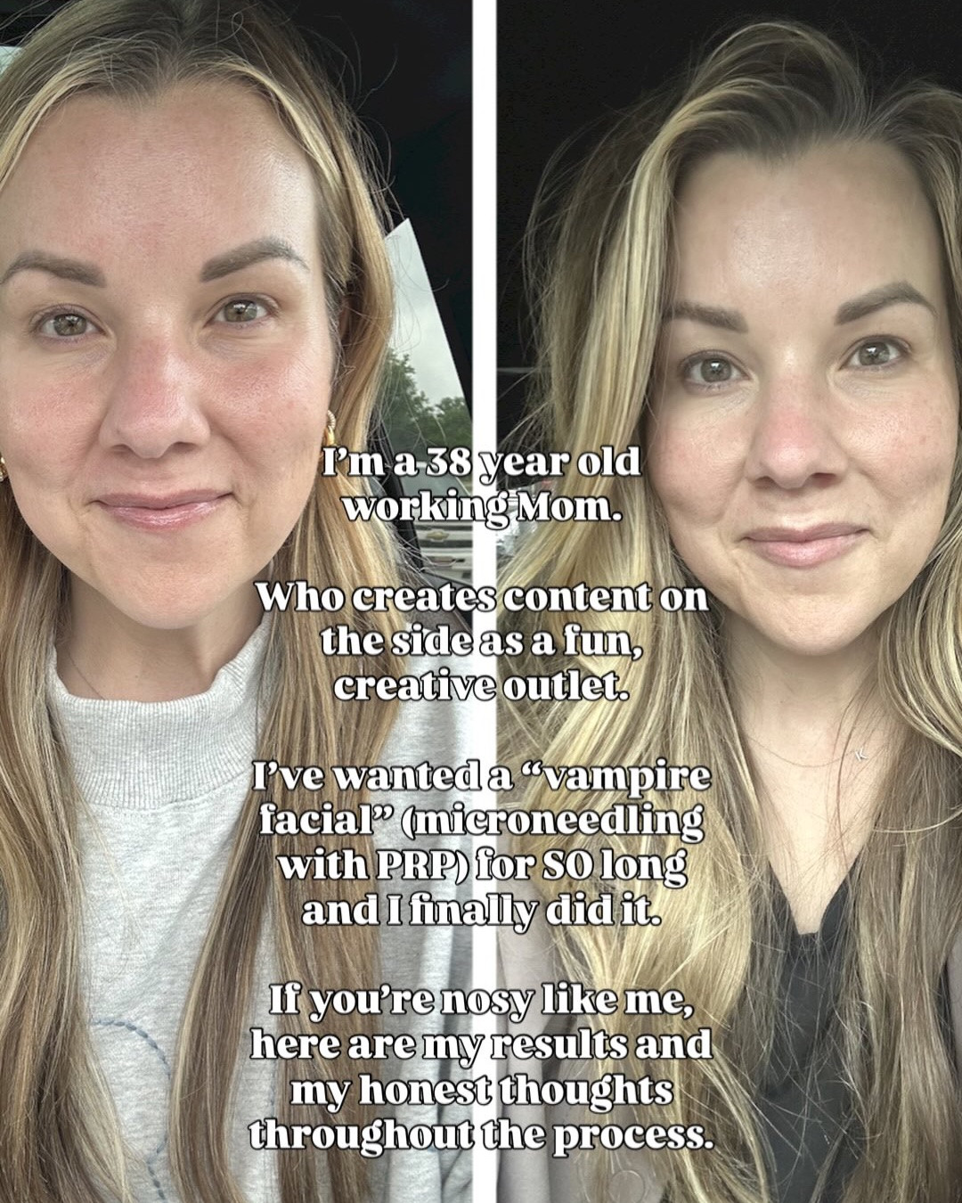 I’m a 38 year old working Mom.

Who creates content on the side as a fun, creative outlet. 

I’ve wanted a “vampire facial” (microneedling with PRP) for a really long time and I finally did it. Here are my results and my honest thoughts throughout the process.

The details…

Microneedling with PRP (aka the Vampire facial) is a powerful microneedling treatment using your own blood’s platelet-rich plasma (PRP) to stimulate collagen production and give you that fresh, youthful glow. 

Needles create tiny, controlled injuries in the skin, prompting your body to naturally produce new collagen and elastin for firmer, more youthful skin. When paired with PRP, packed with natural growth factors, this treatment helps supercharge the skin’s repair process! 

Benefits: 
Minimizes fine lines and wrinkles
Decreases pore size 
stimulates collagen production 
Improves scarring
Evens skin tone and texture 
Reduces build up of dead skin by increasing cell turnover rate

#LTKselfcare #LTKBeauty